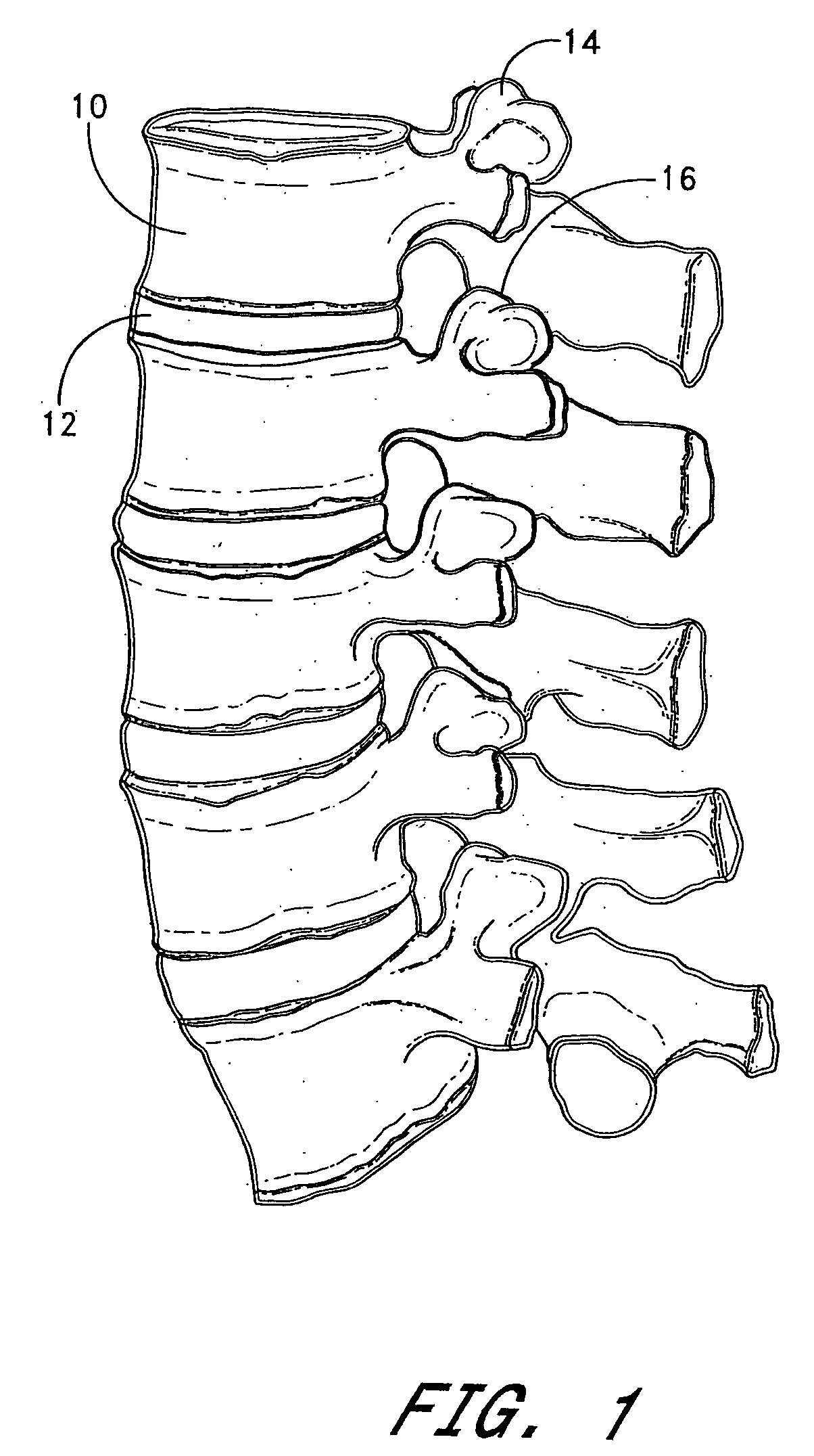 Method of spinal fixation using adhesive media