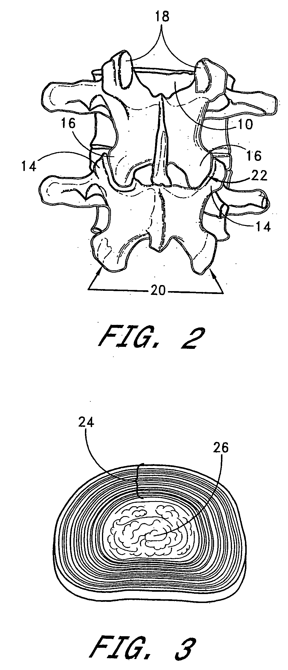 Method of spinal fixation using adhesive media