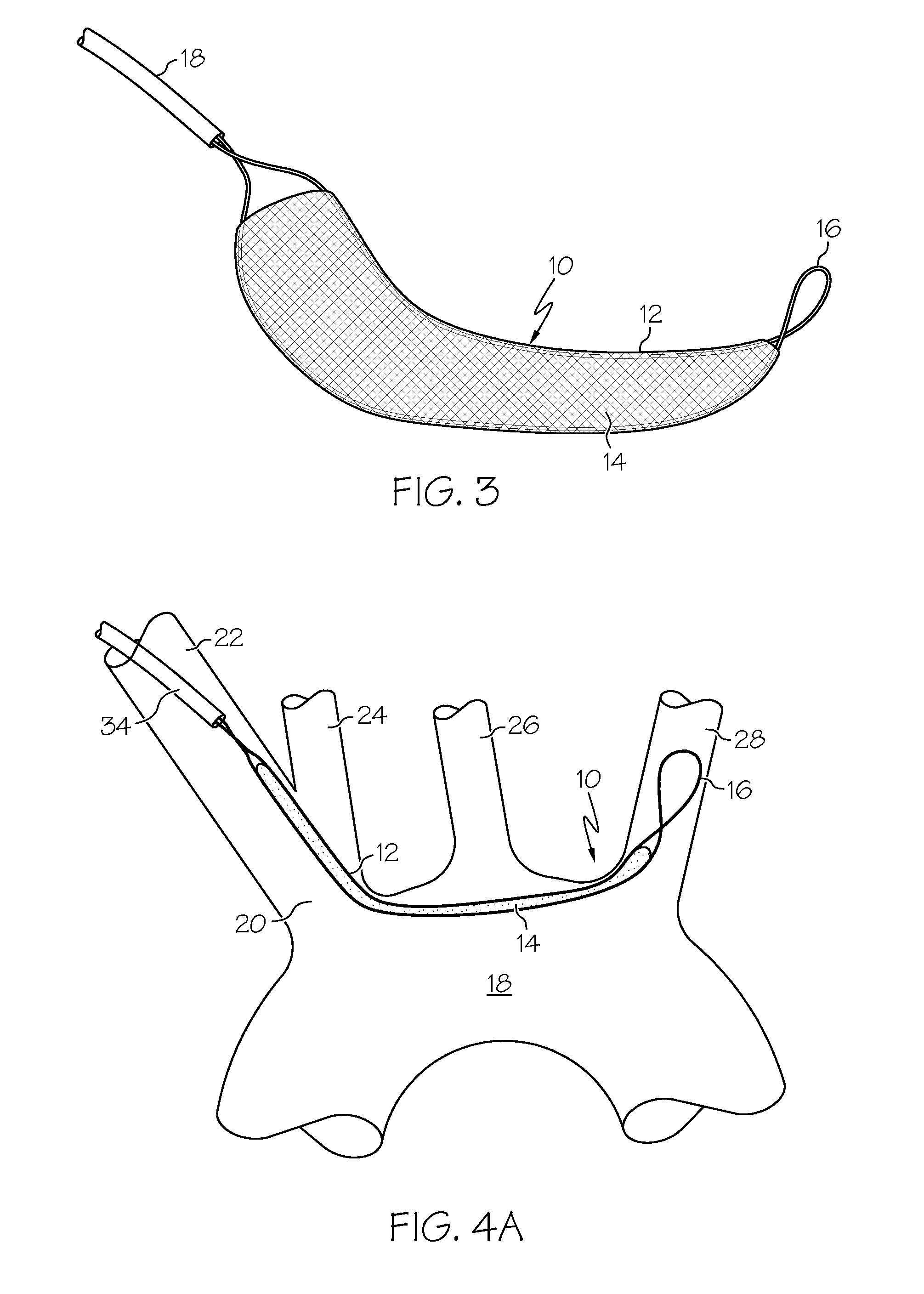 Embolic protection device and method