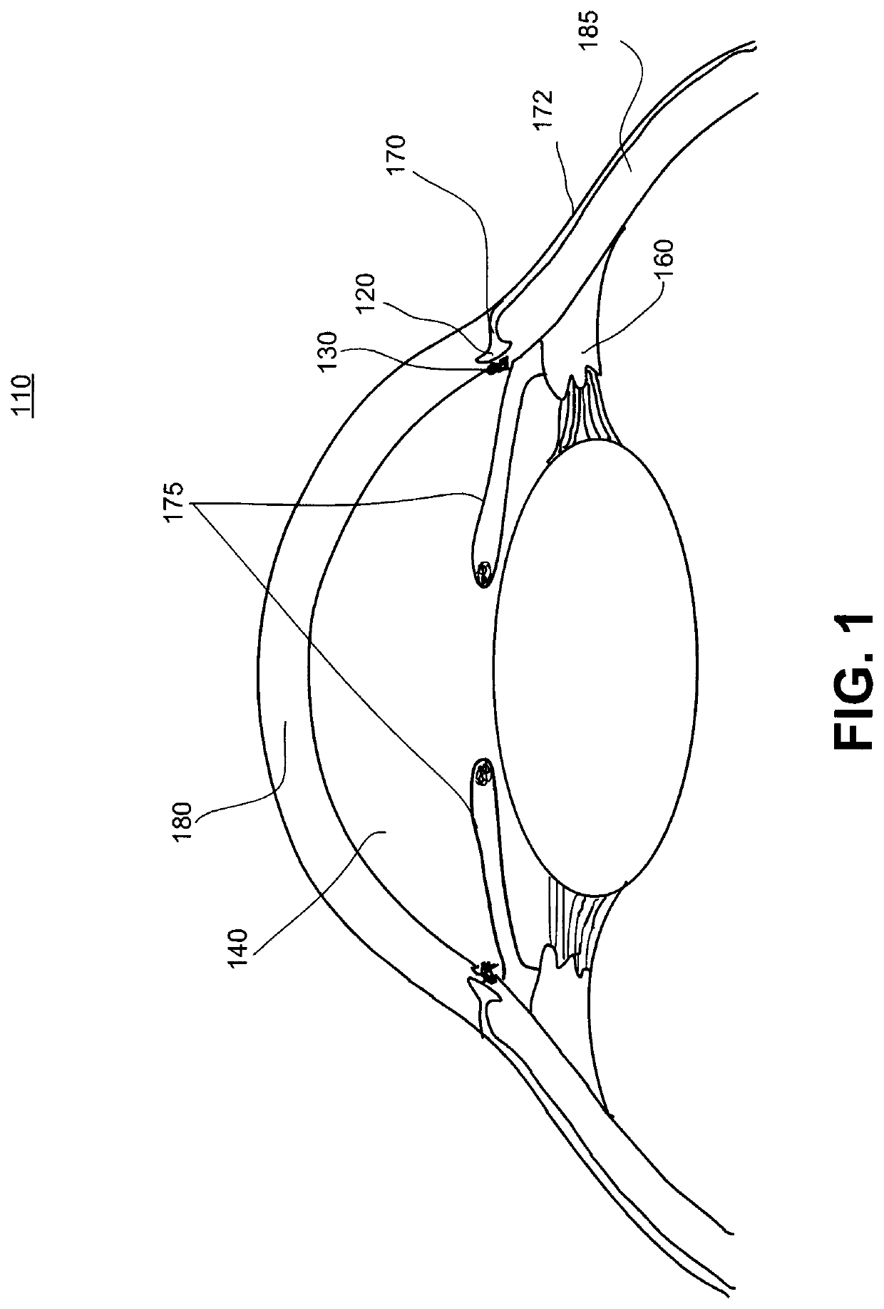 Method and system for laser automated trabecular excision