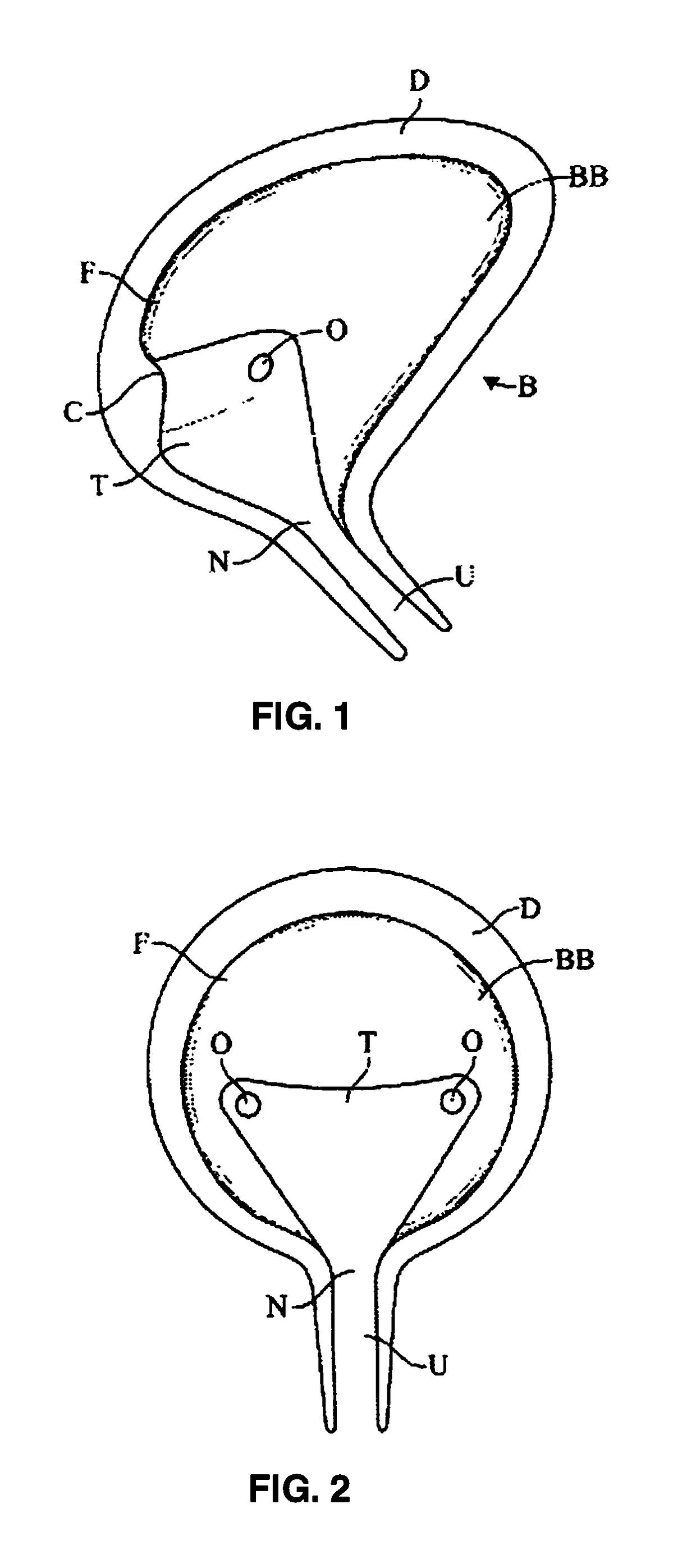 Methods and devices for treating pelvic conditions