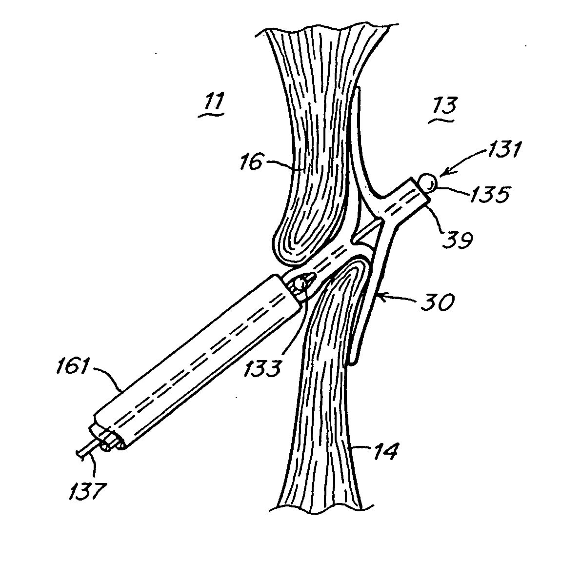 Patent foramen ovale (PFO) closure device with linearly elongating petals