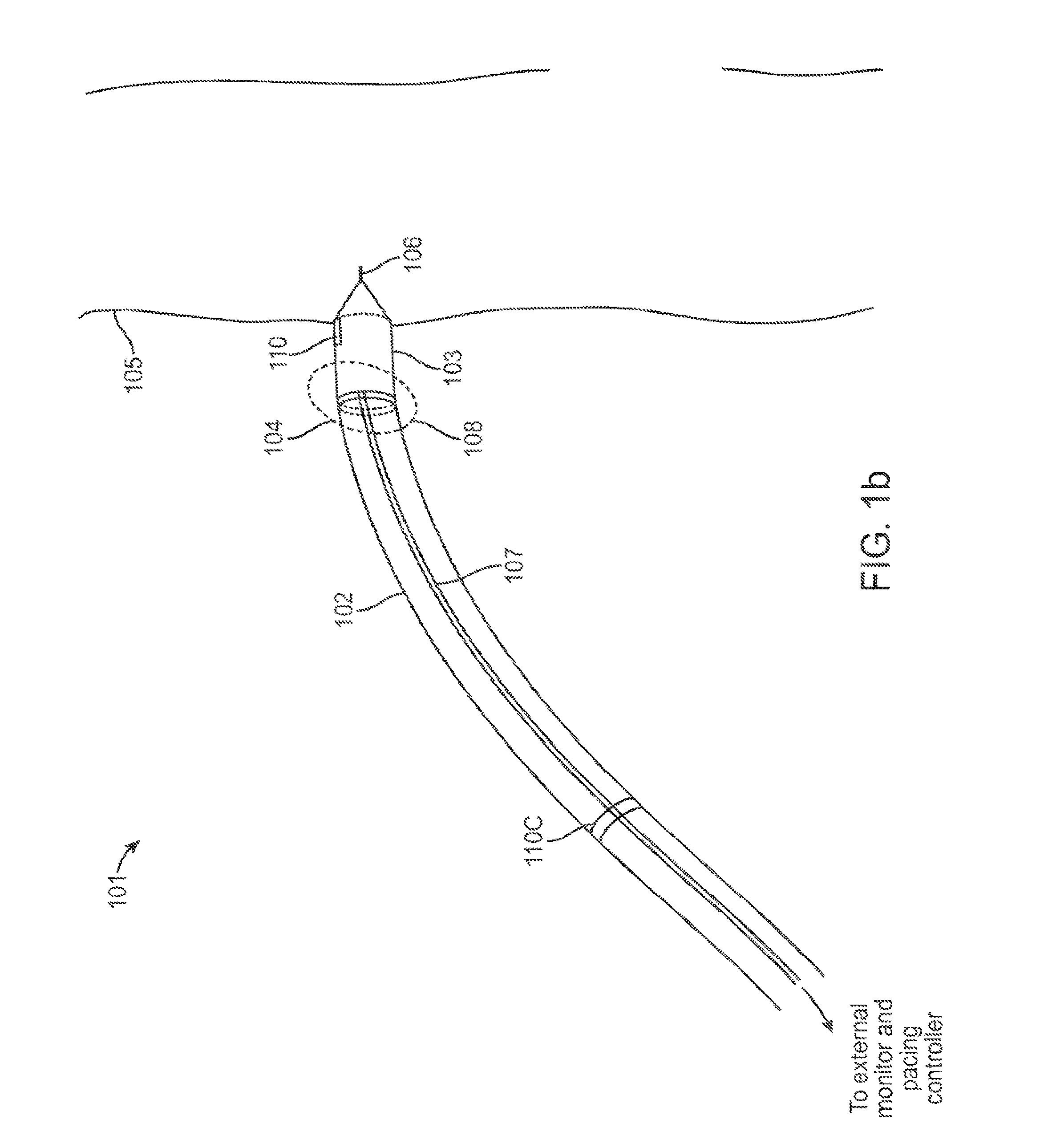 Temporary electrode connection for wireless pacing systems