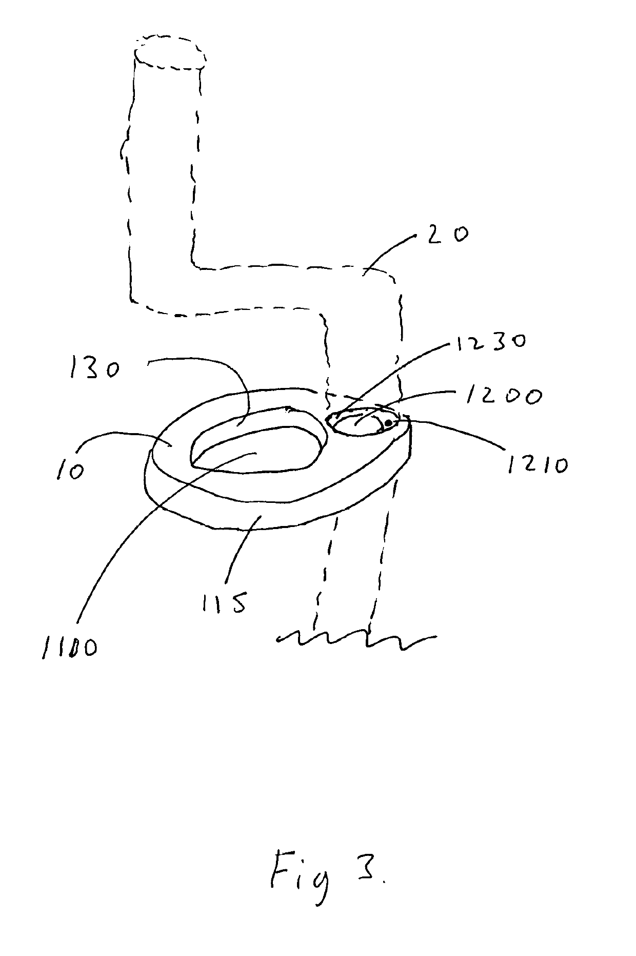 Bulging Torus Balloon