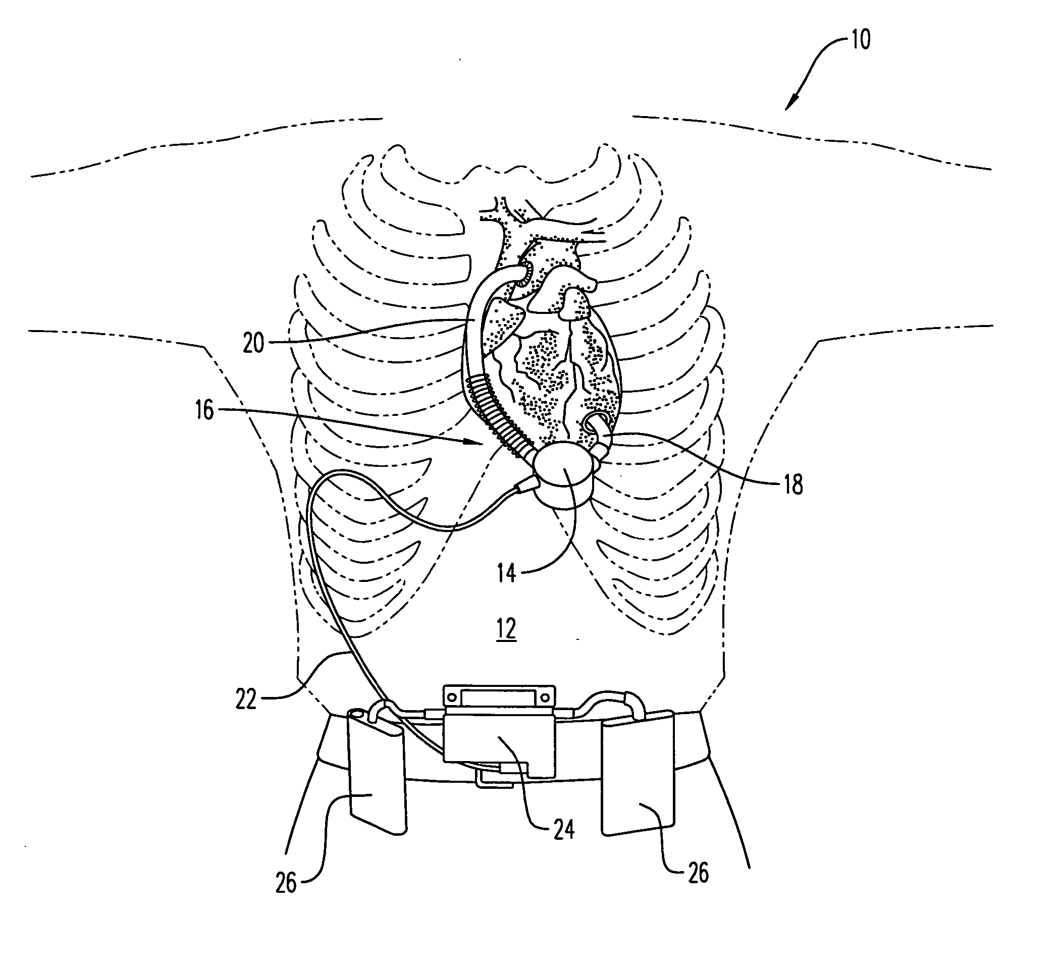 Adjustable coupling mechanism for the conduit on a ventricular assist device