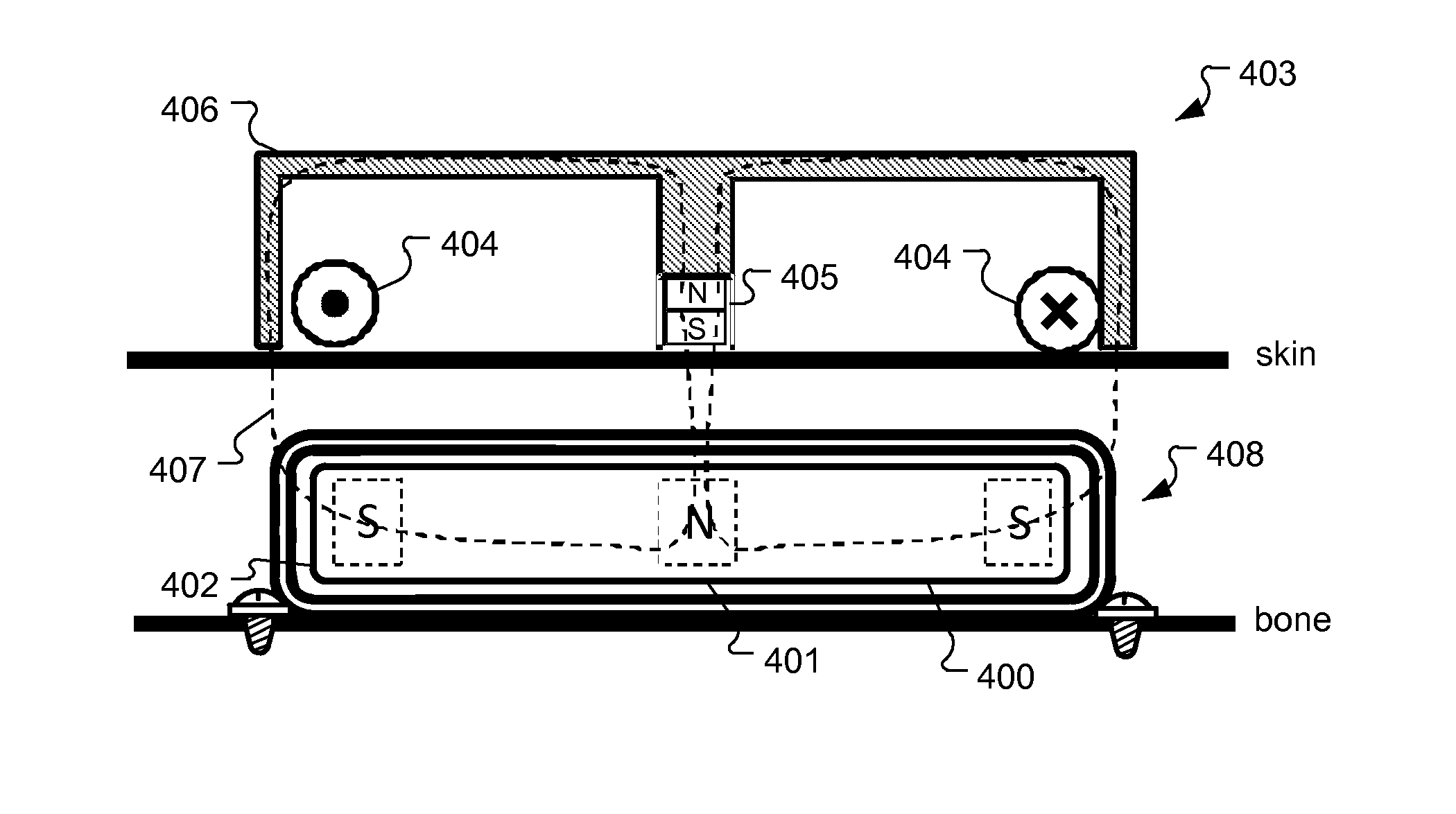 Symmetric Magnet Arrangement for Medical Implants