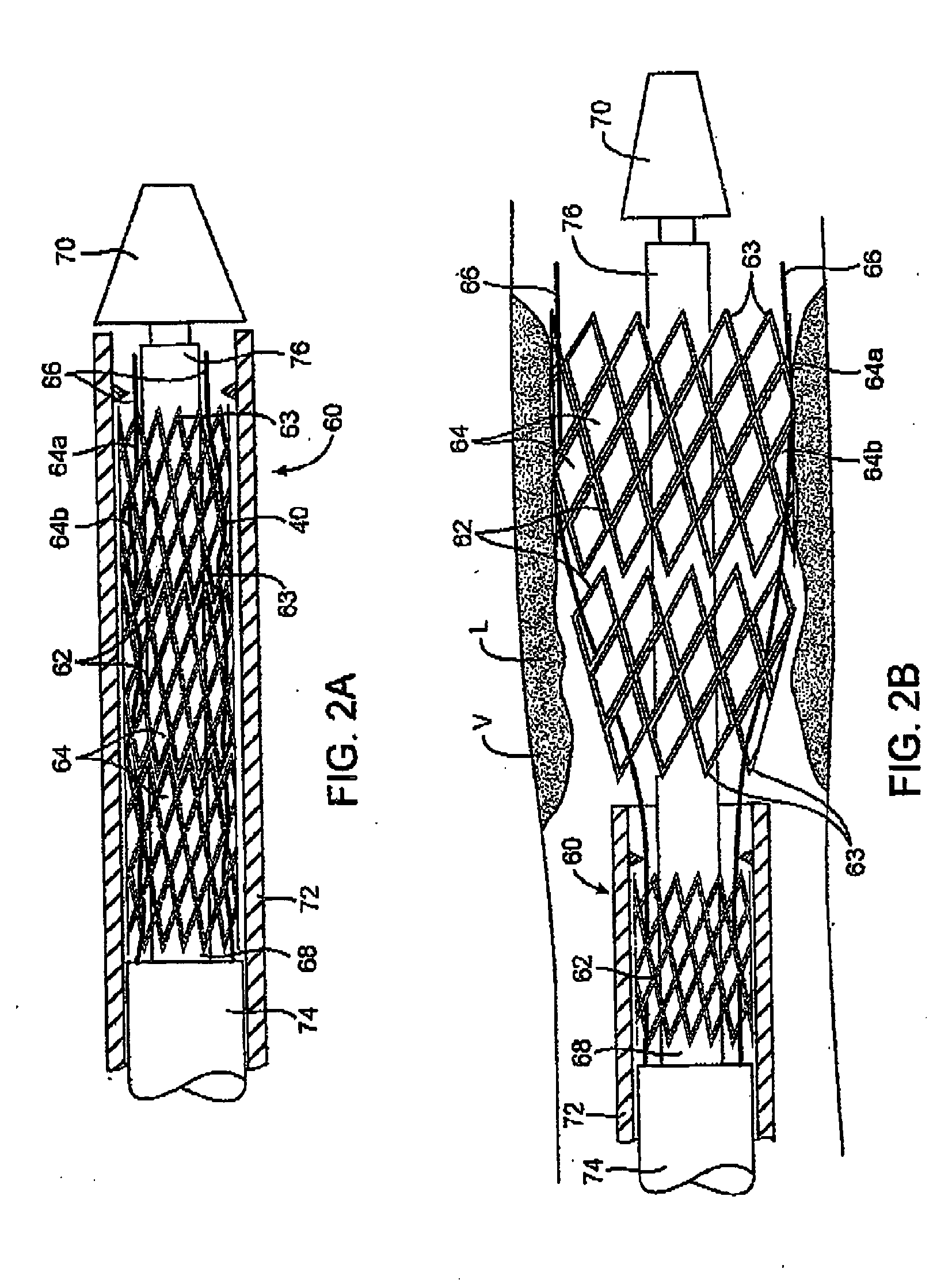 Devices and methods for controlling expandable prosthesis during develoyment