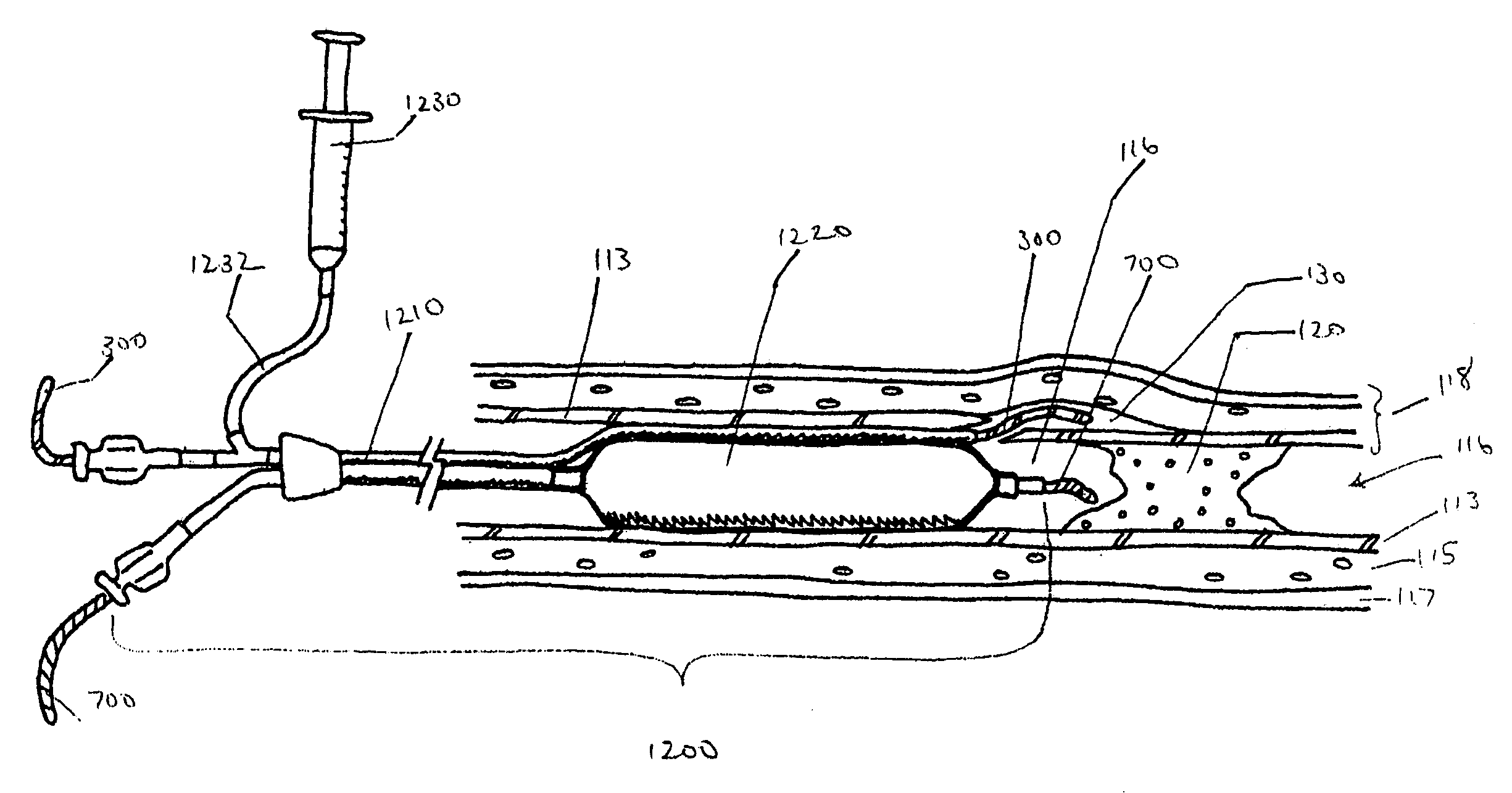 Endovascular devices and methods for exploiting intramural space