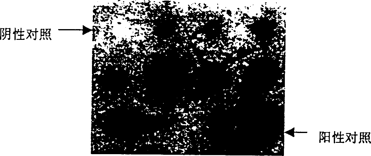 Method for preparing medicine using silkworm expressed human beta interferon