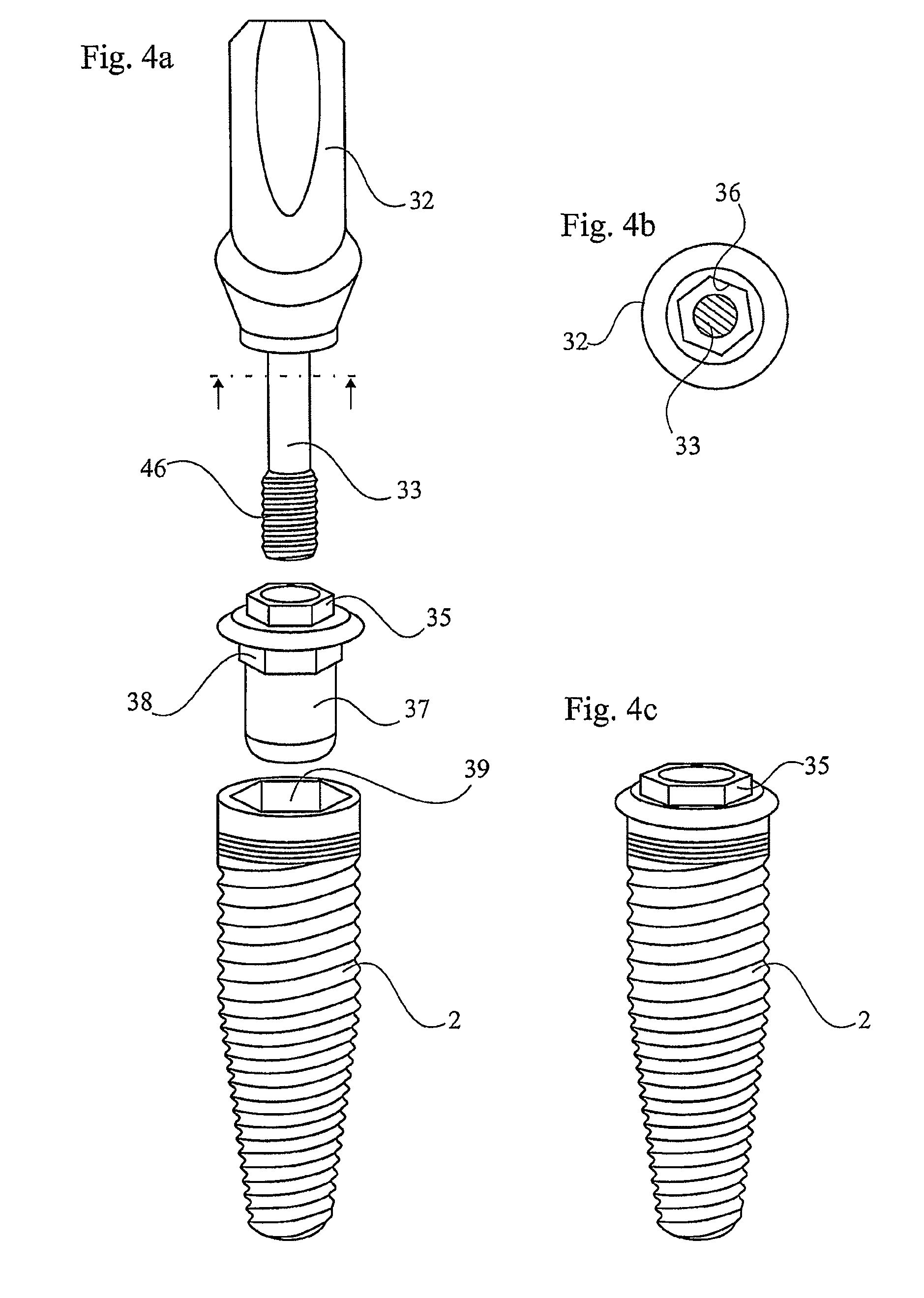 Device for securing a dental implant in bone tissue, a method for making a surgical template and a method of securing a dental implant in bone tissue