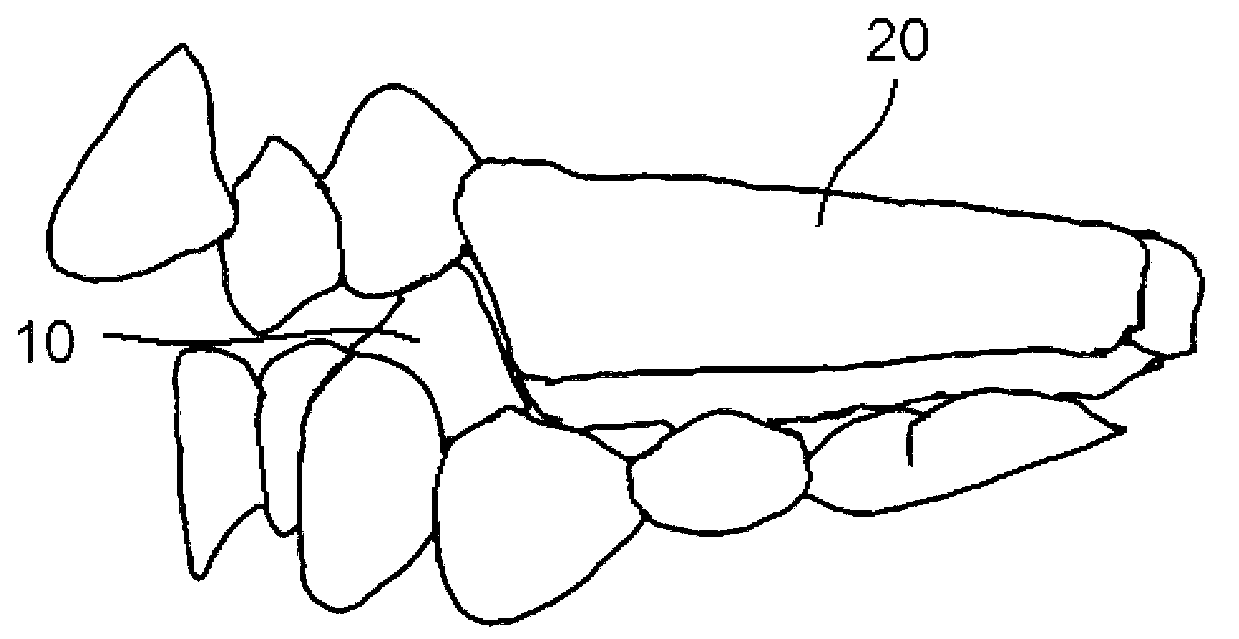 Method for manufacturing submaxilla anterior guidance device