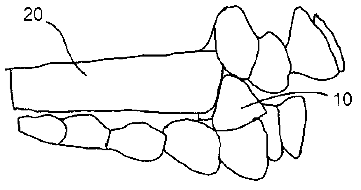 Method for manufacturing submaxilla anterior guidance device