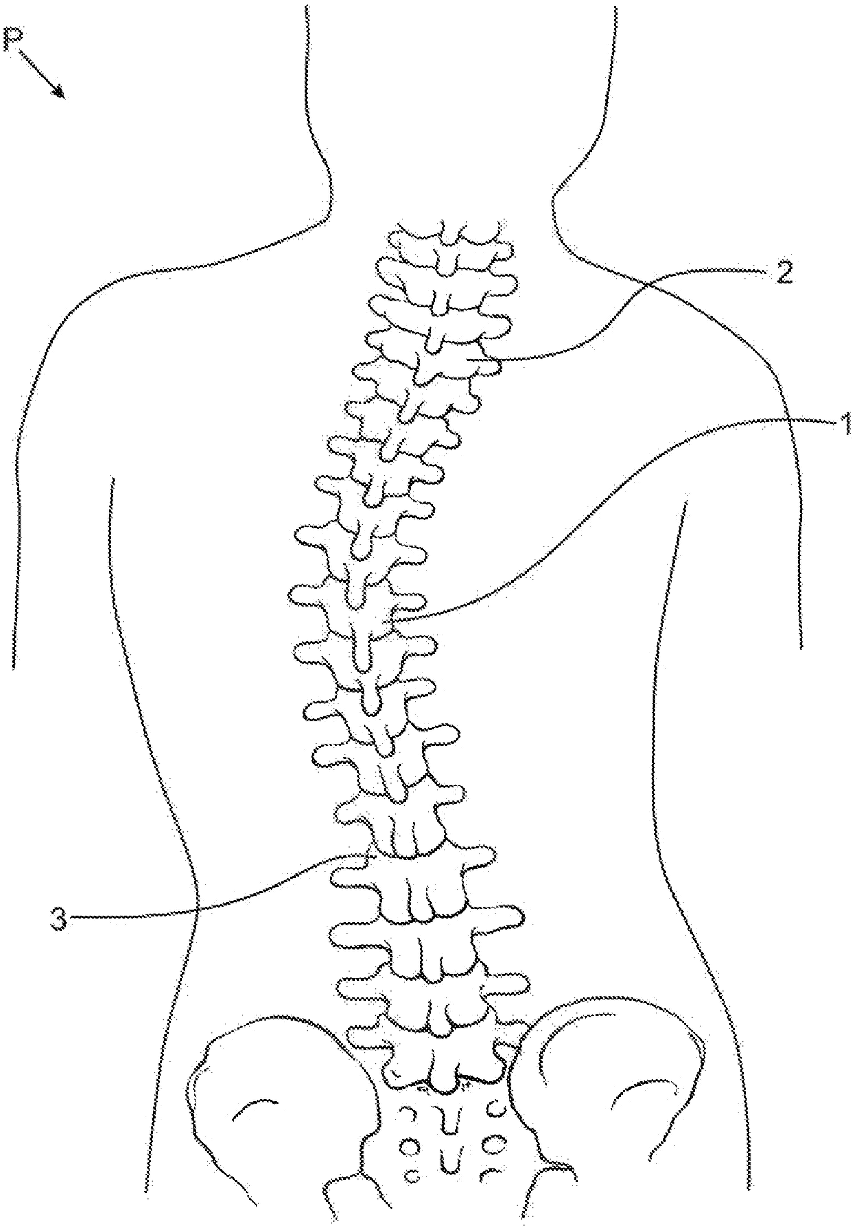 Subcutaneous implantable device for gradually aligning a spine and subcutaneous implantable device for gradually lengthening a bone