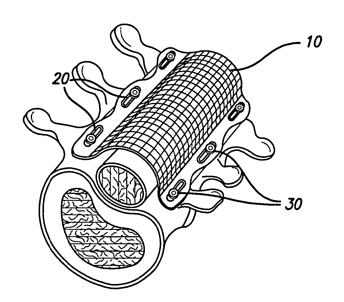 Bone anchored surgical mesh