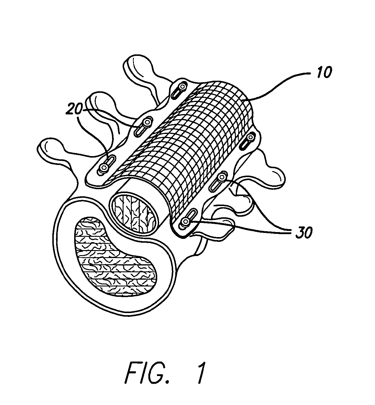 Bone anchored surgical mesh