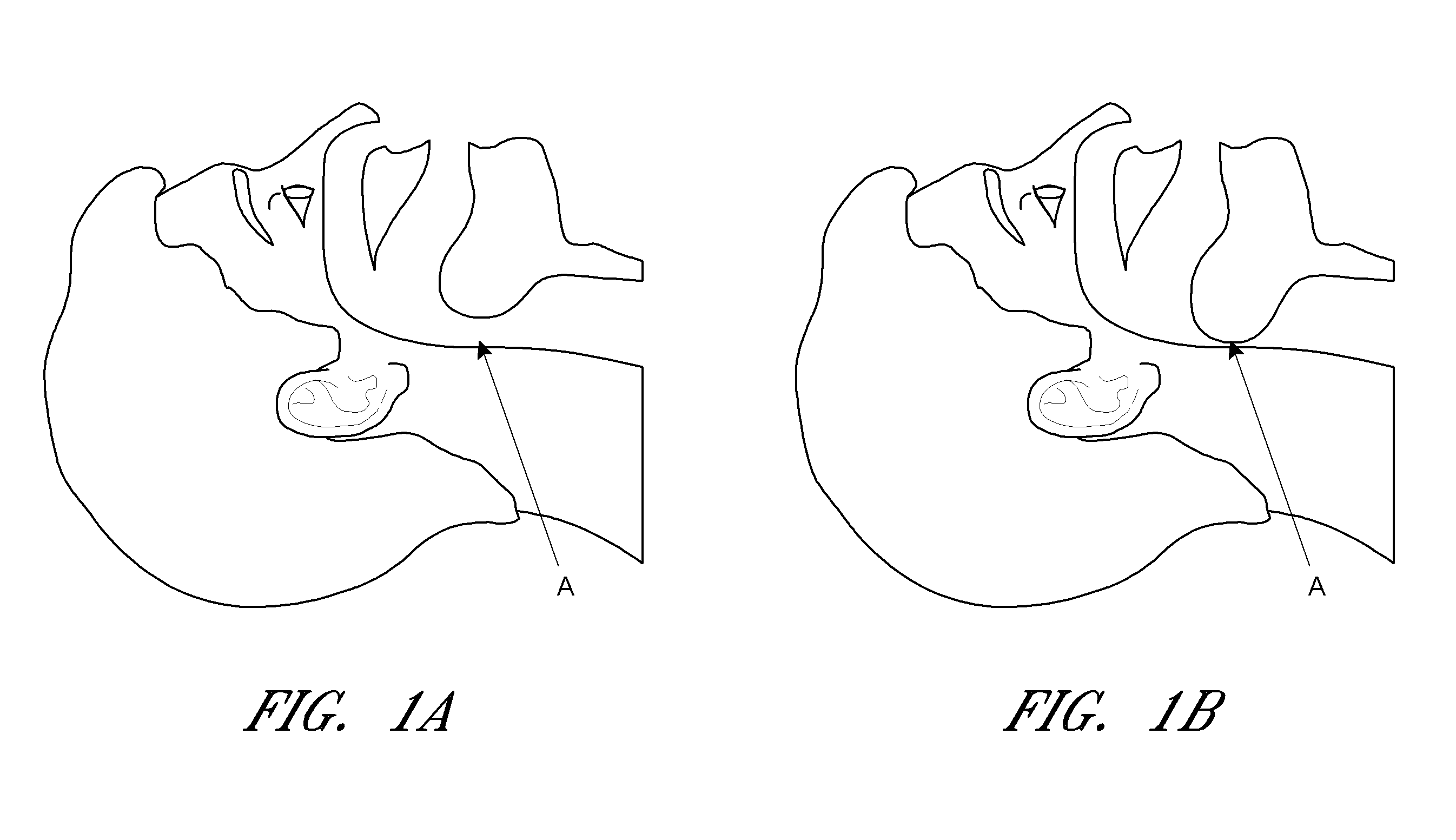 Auto-feedback valve for a sleep apnea device