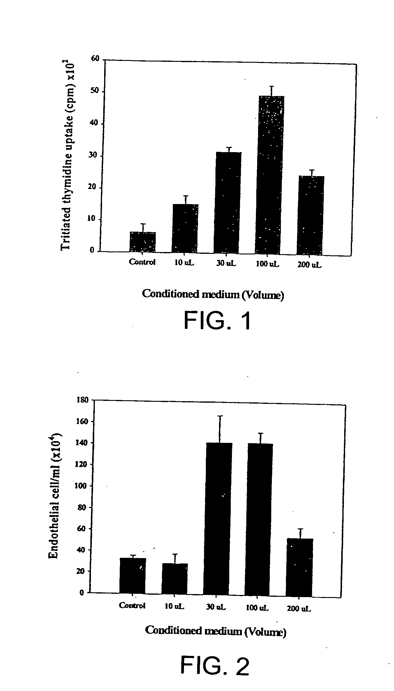 Intramyocardial injection of autologous bone marrow