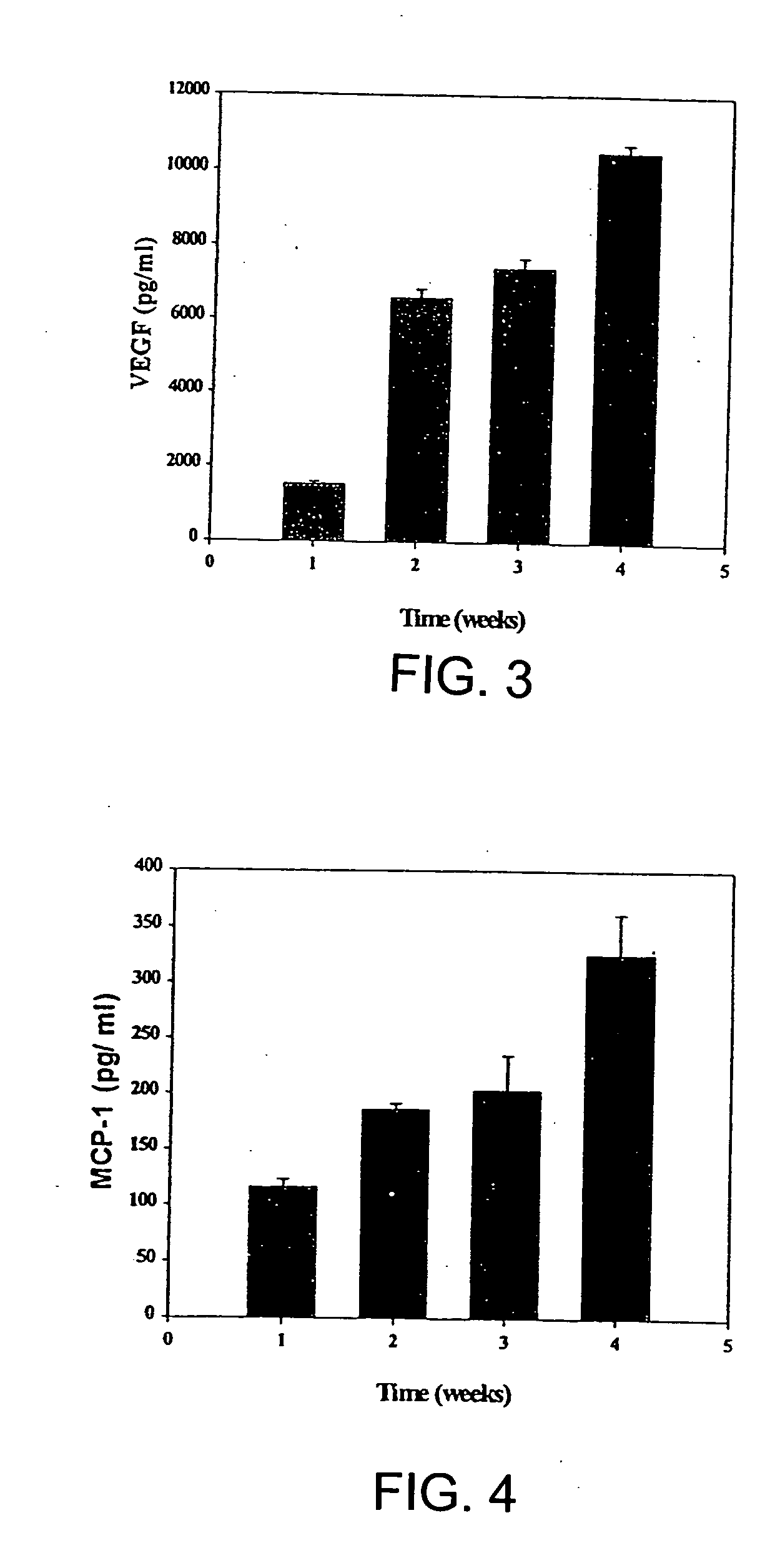 Intramyocardial injection of autologous bone marrow