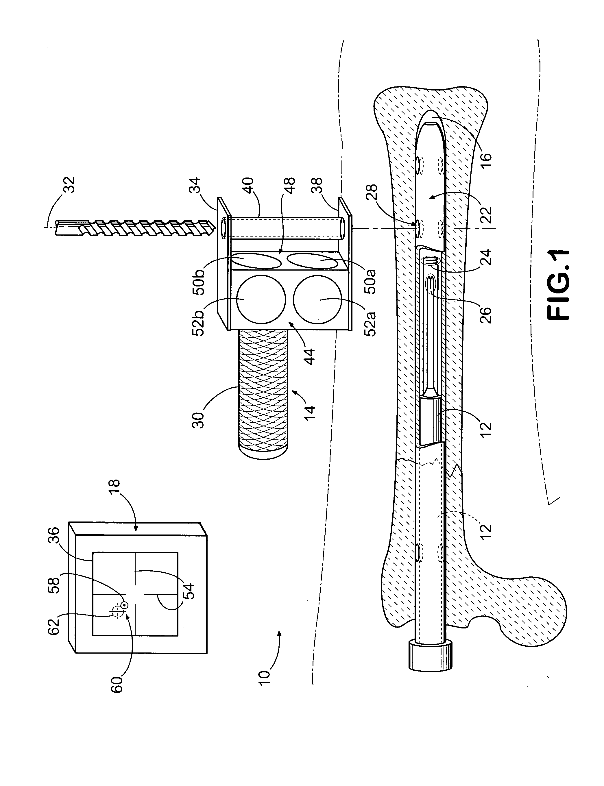 Method and apparatus for distal targeting of locking screws in intramedullary nails