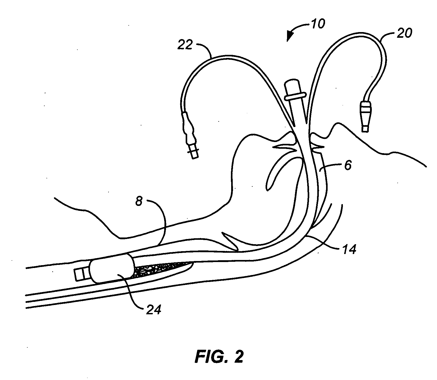 Mucus slurping endotracheal tube