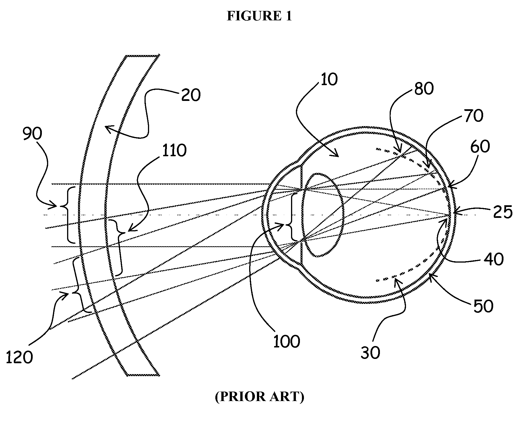 Method and apparatus for controlling peripheral image position for reducing progression of myopia