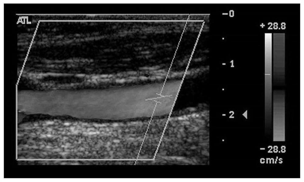 A carotid artery aging prediction method based on elastic modulus