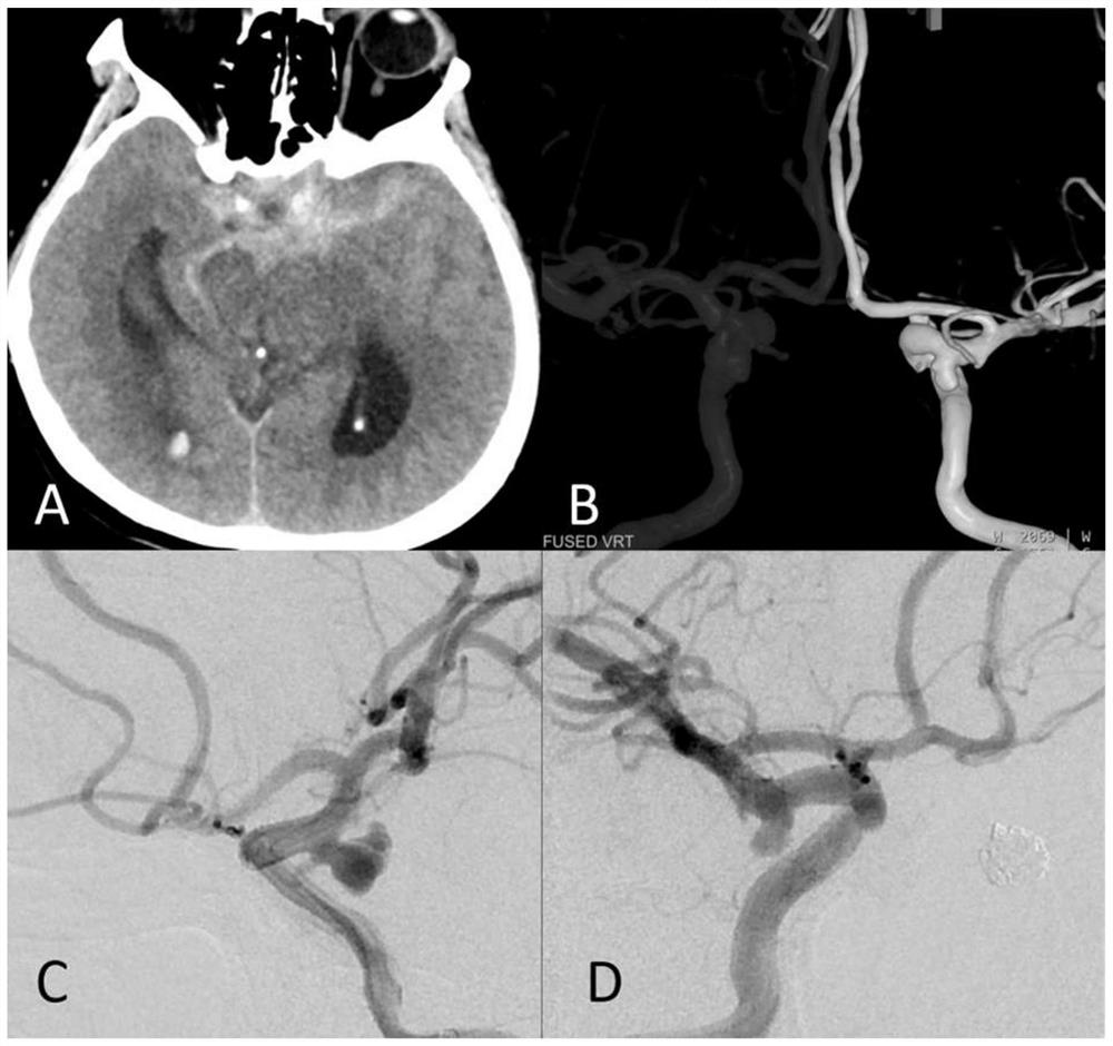 Method and device for constructing model for predicting intracranial aneurysm rupture