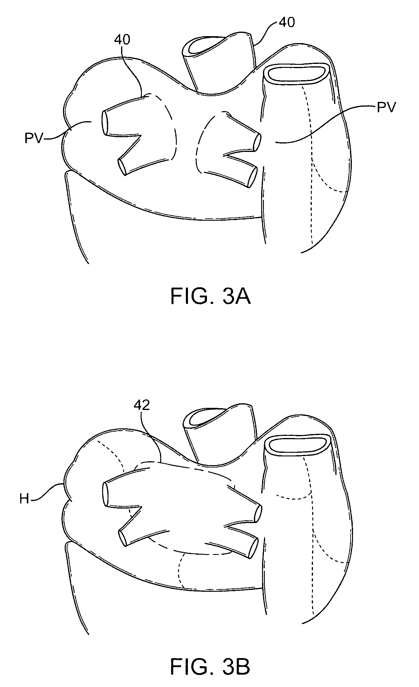 Radiosurgical ablation of the myocardium