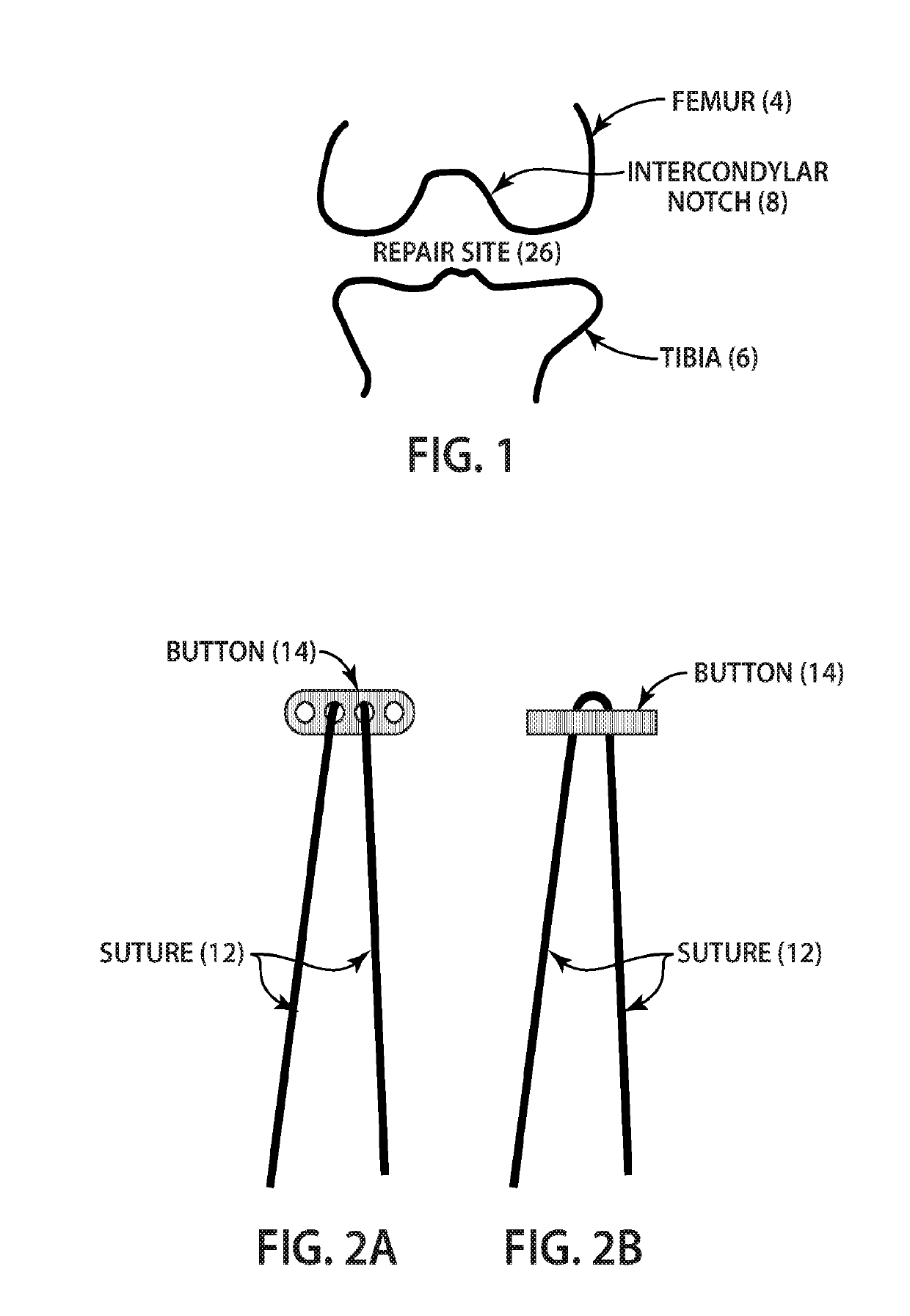 Indirect method of articular tissue repair