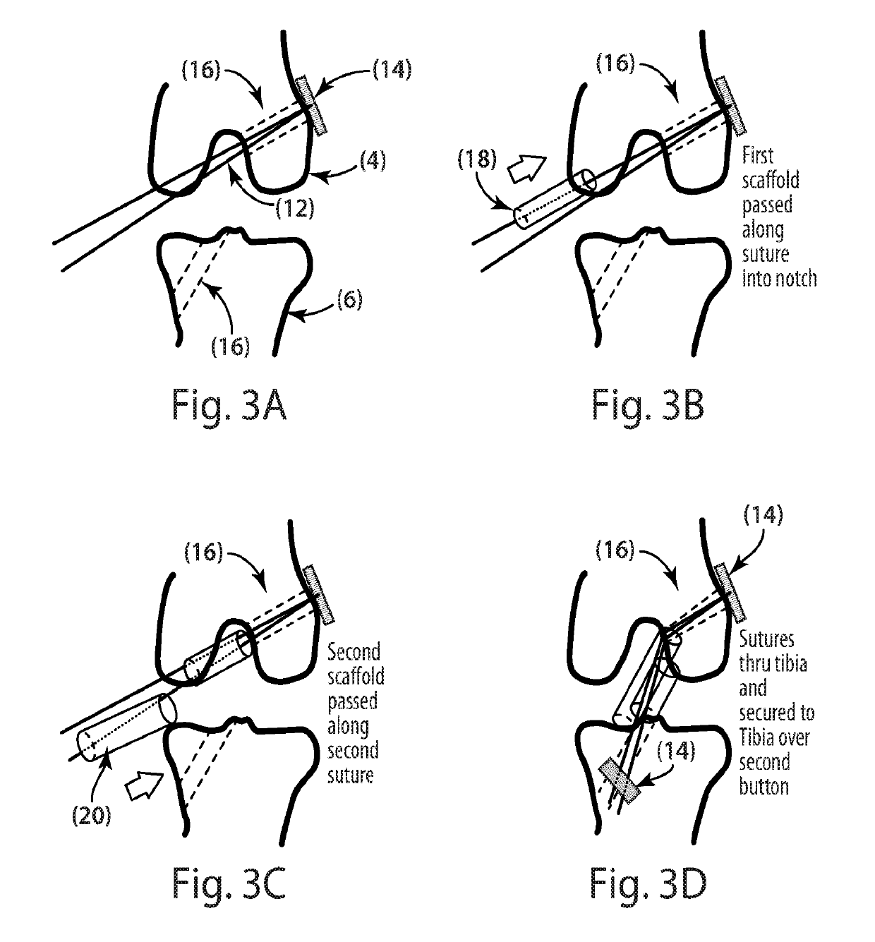 Indirect method of articular tissue repair