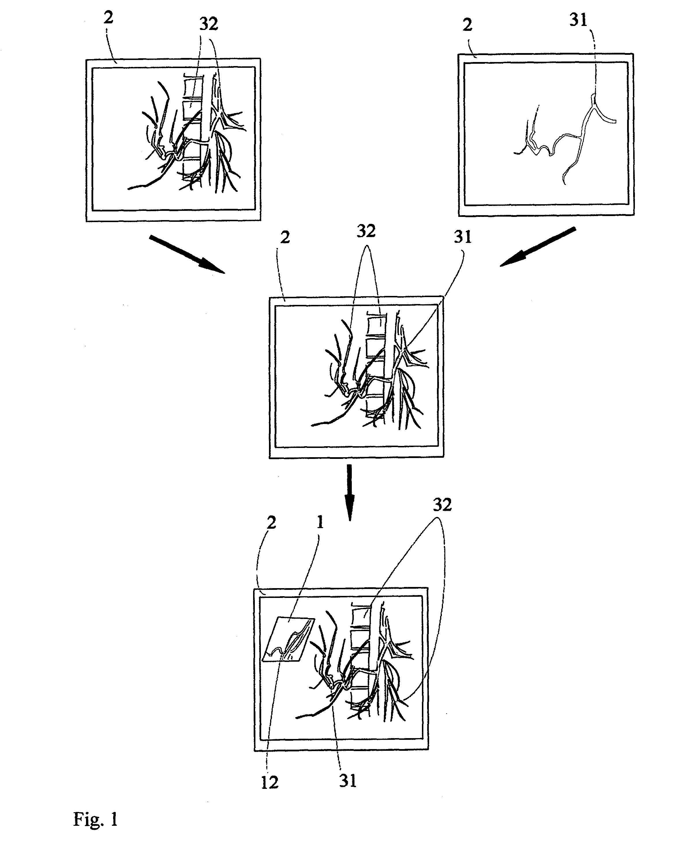 Virtual penetrating mirror device for visualizing virtual objects in angiographic applications