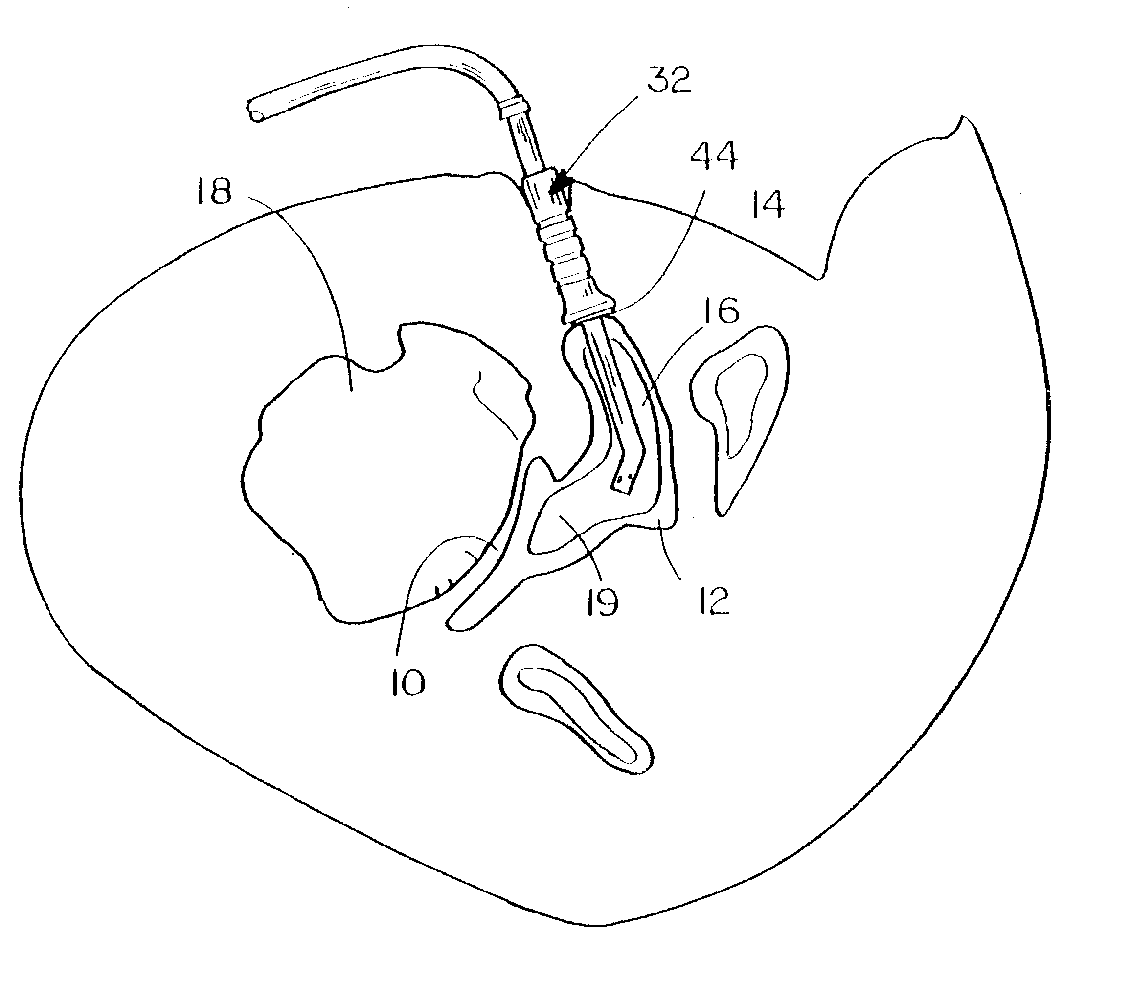 Method and means for cementing a liner onto the face of the glenoid cavity of a scapula