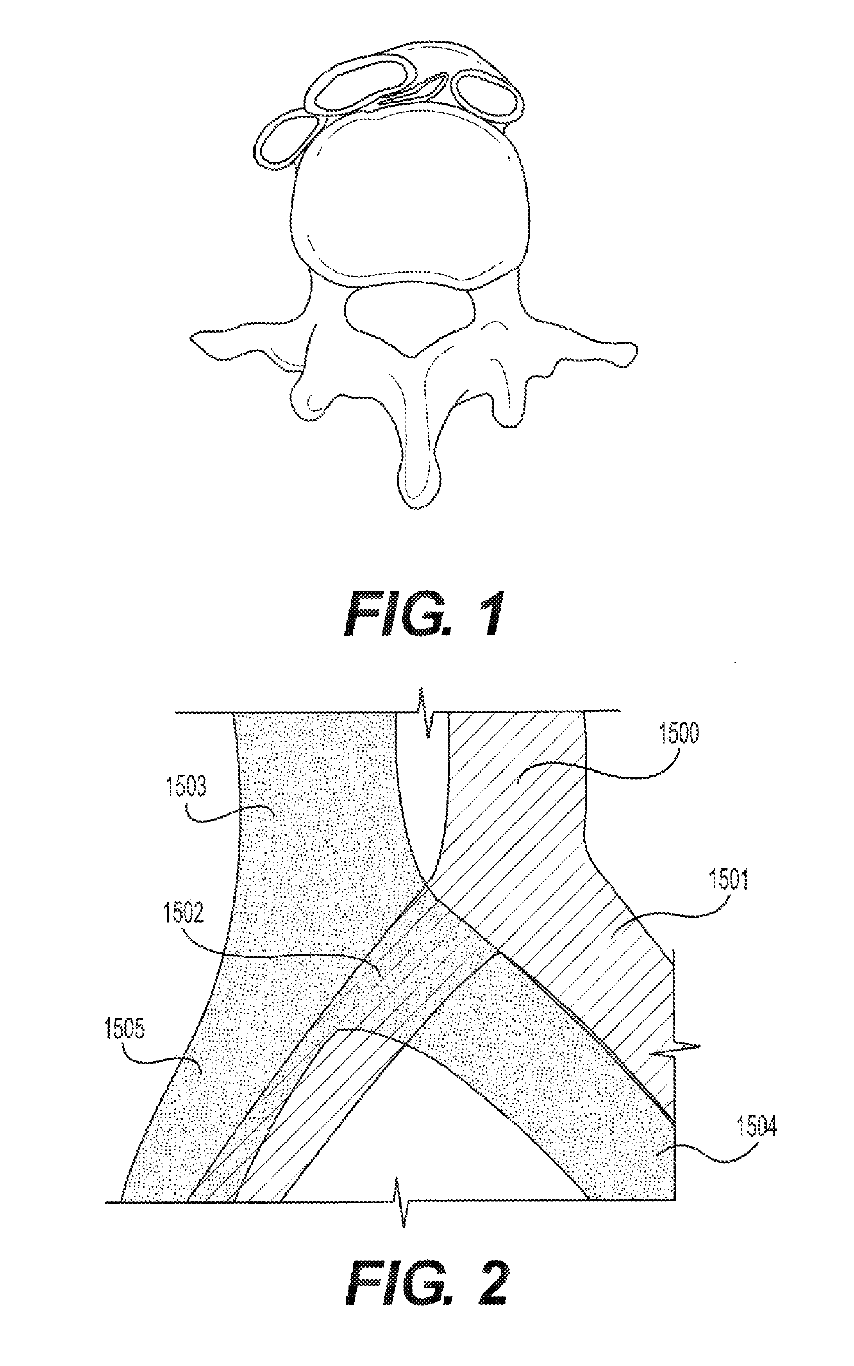 Tapering stent