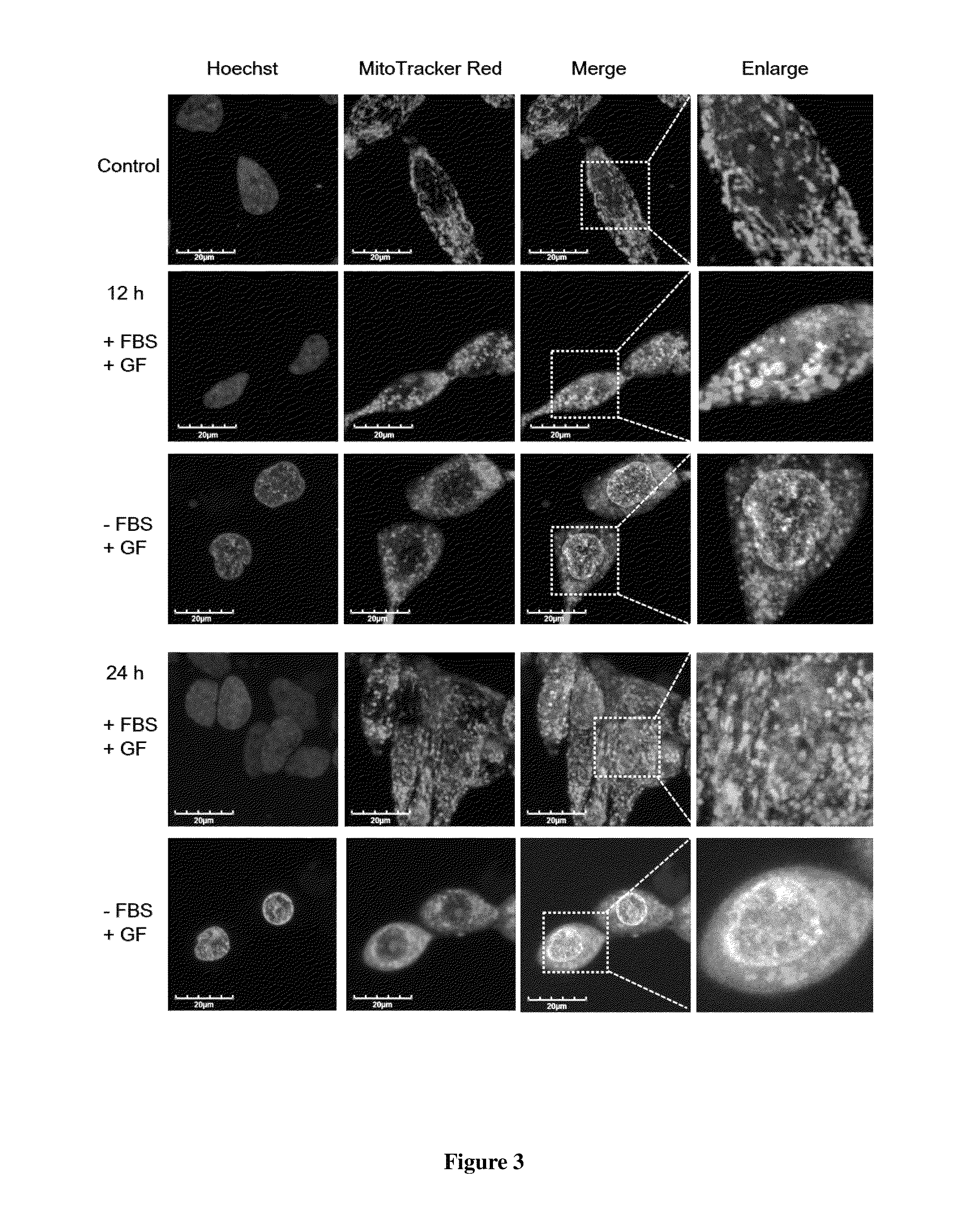 Pharmaceutical composition comprising guttiferone F for the treatment of prostate cancer