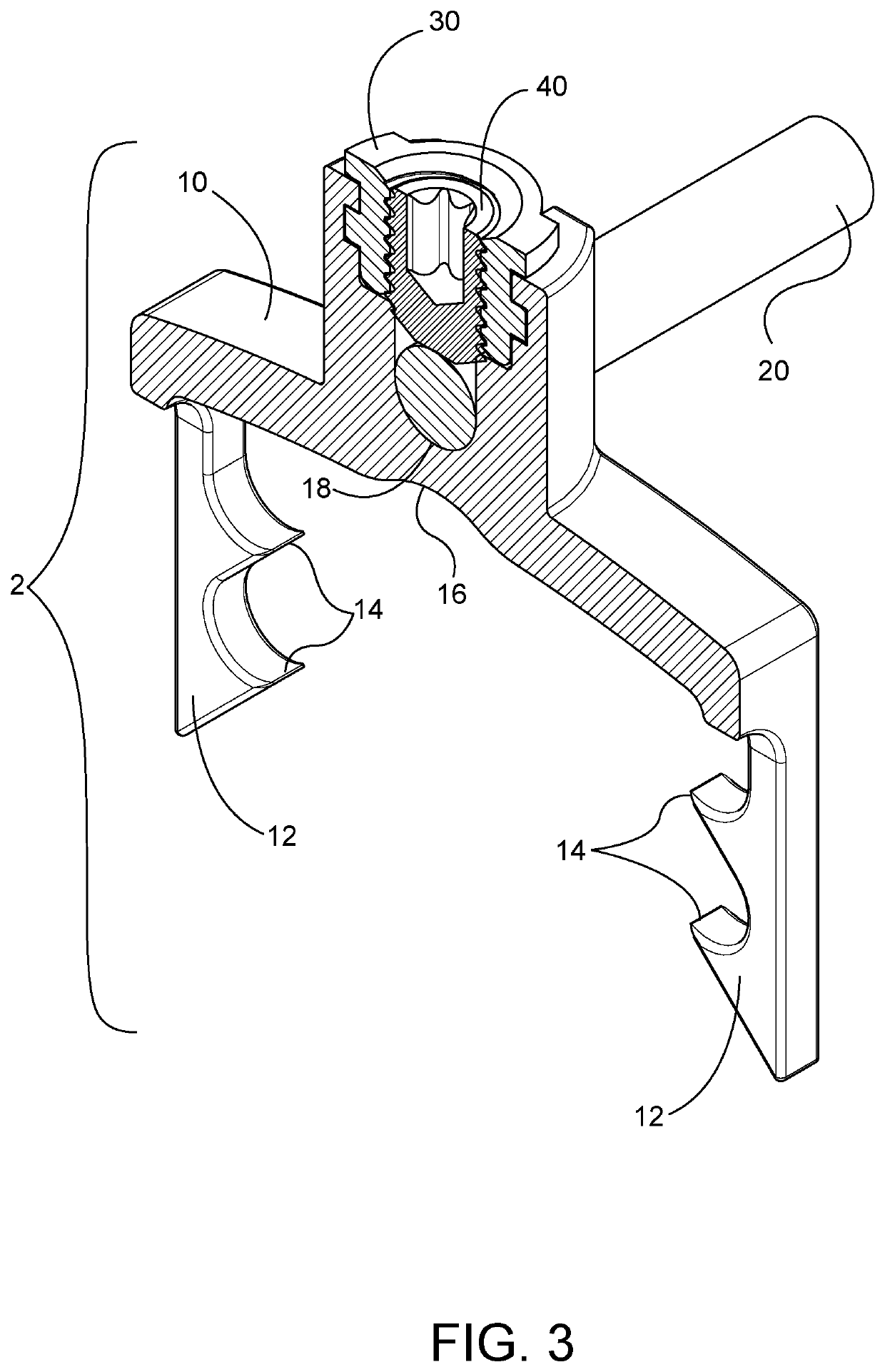 Growth and motion sparing tethers and bone anchor implants for the treatment and correction of spine deformities