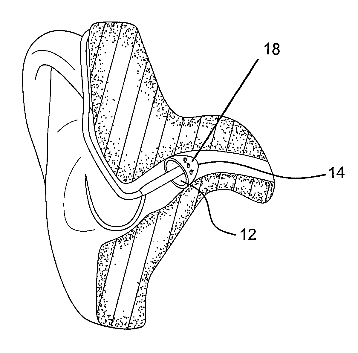 Open Ear Fitting