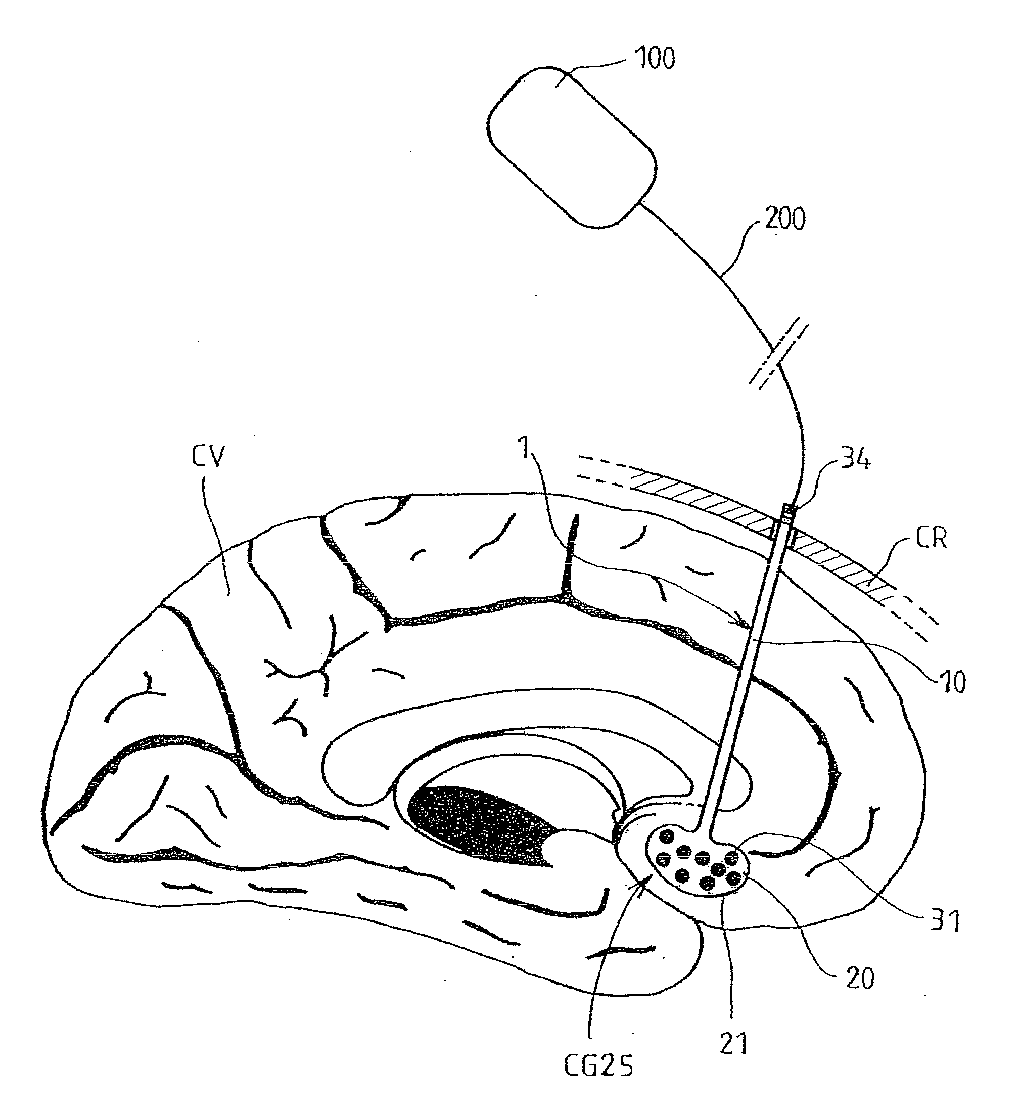 Multiple electrode lead and a system for deep electrical neurostimulation including such a lead