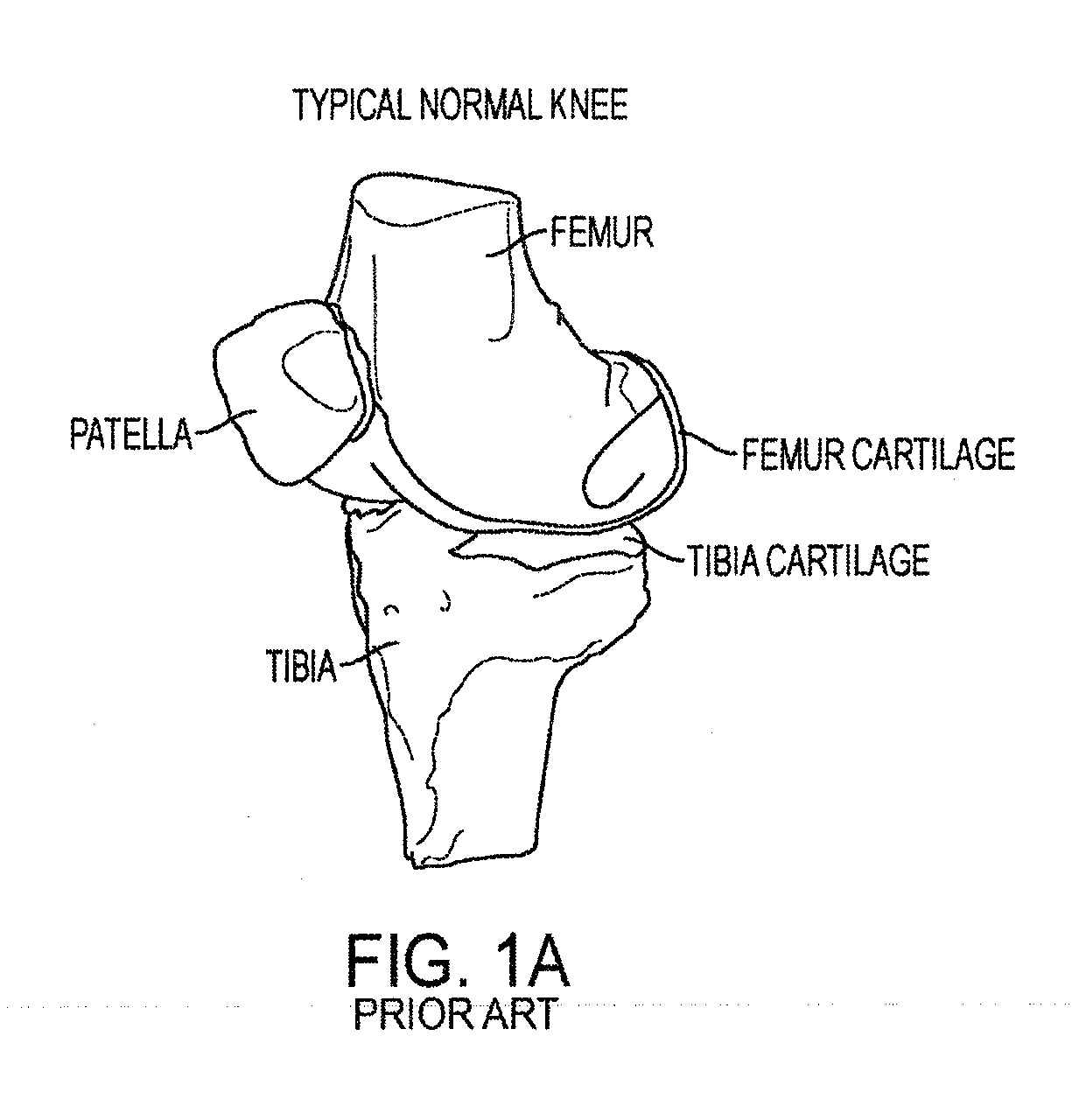 Implant for restoring normal range flexion and kinematics of the knee