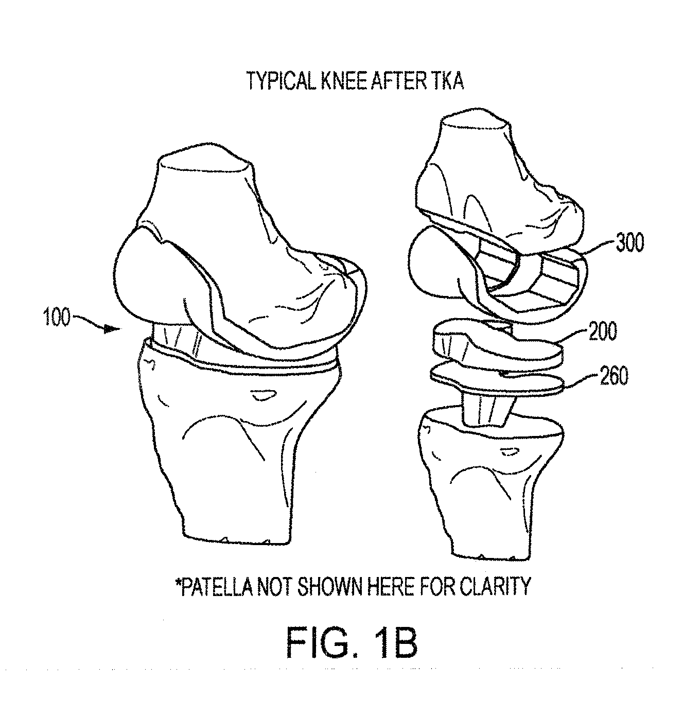 Implant for restoring normal range flexion and kinematics of the knee