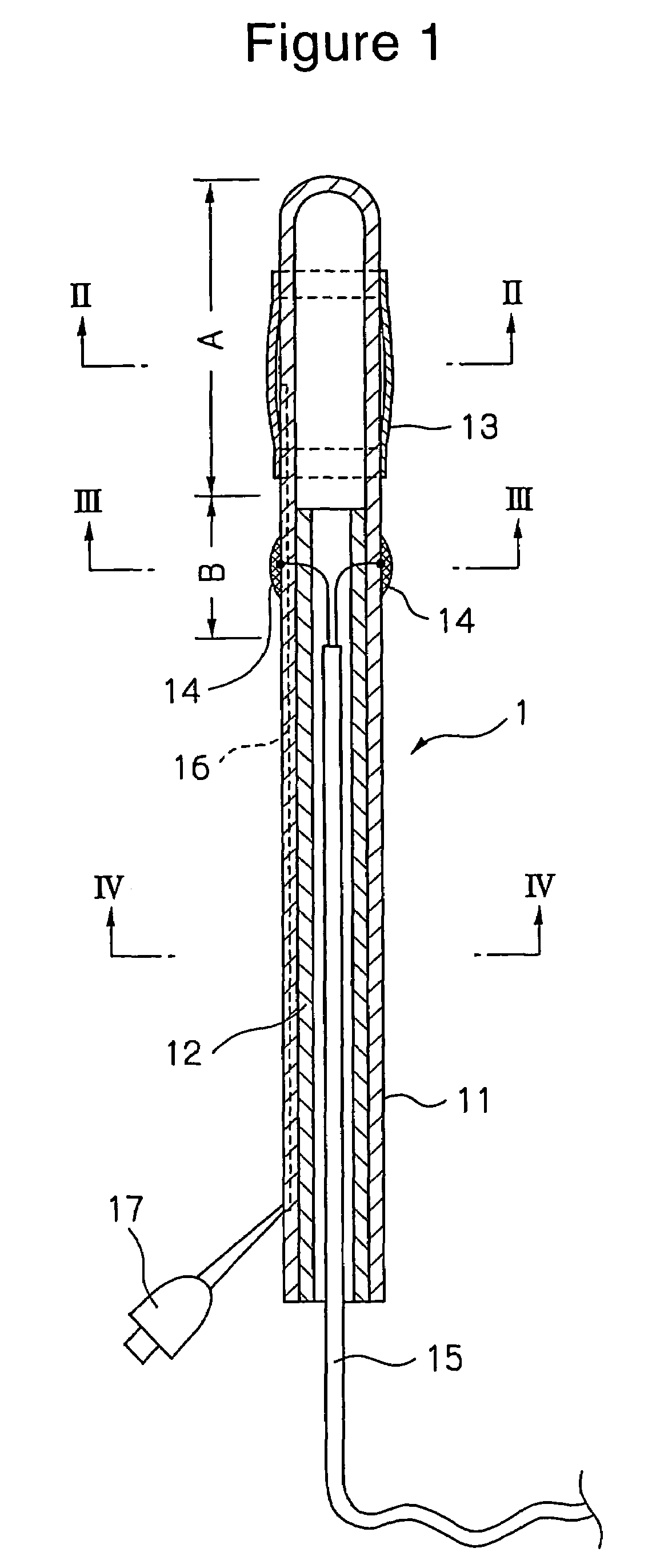 Diagnosis catheter for interstitial cystitis