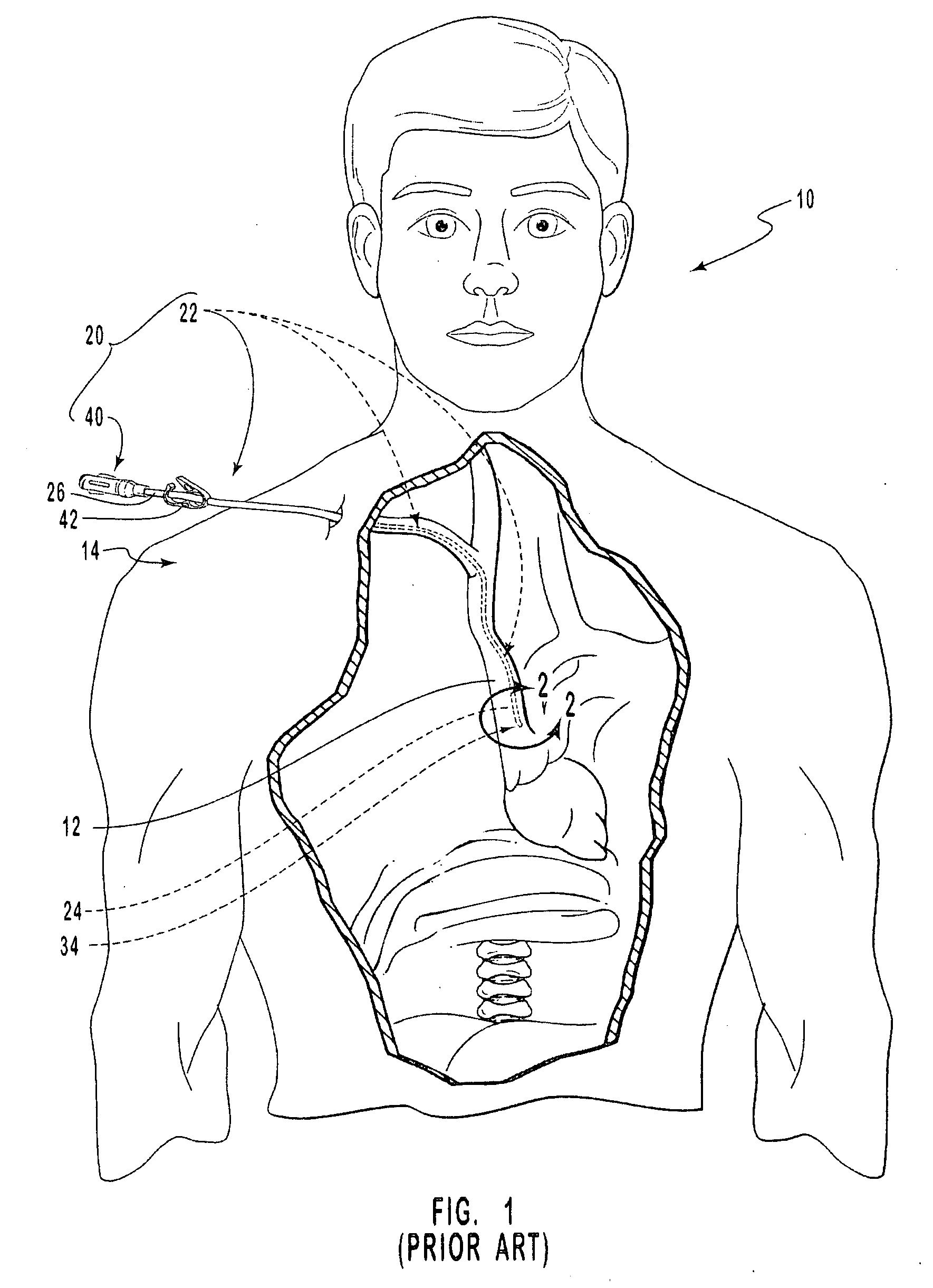 Cardiovascular access catheter with slit valve