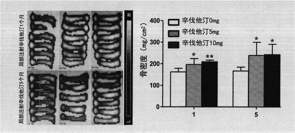 New application of statin compound as topical medicine for preventing and curing osteoporotic fracture