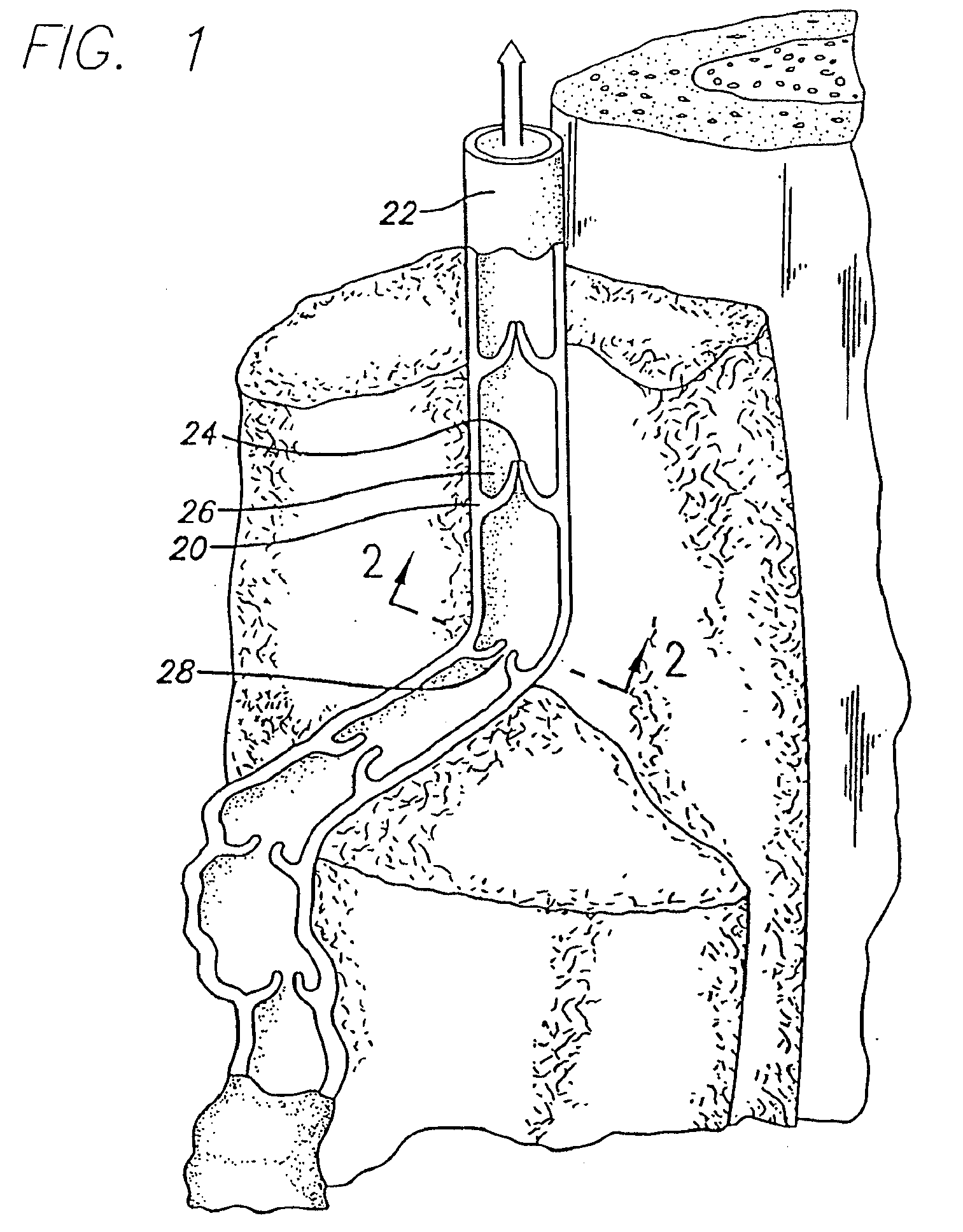 Method and apparatus for applying energy to biological tissue including the use of tumescent tissue compression