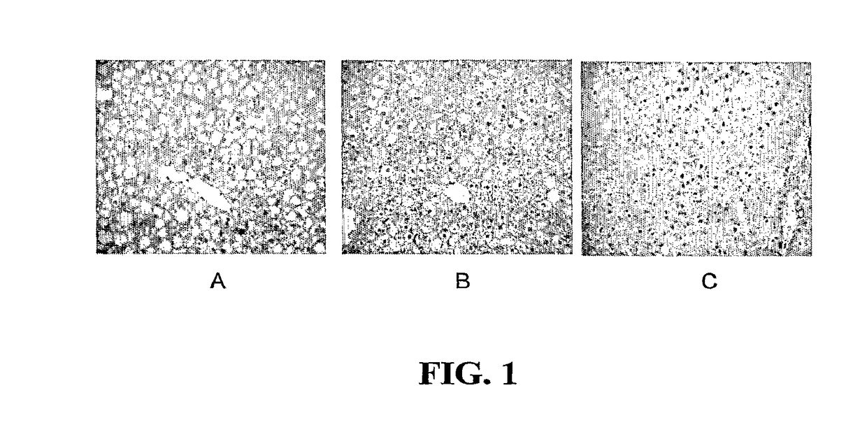 Thyromimetics for the Treatment of Fatty Liver Diseases