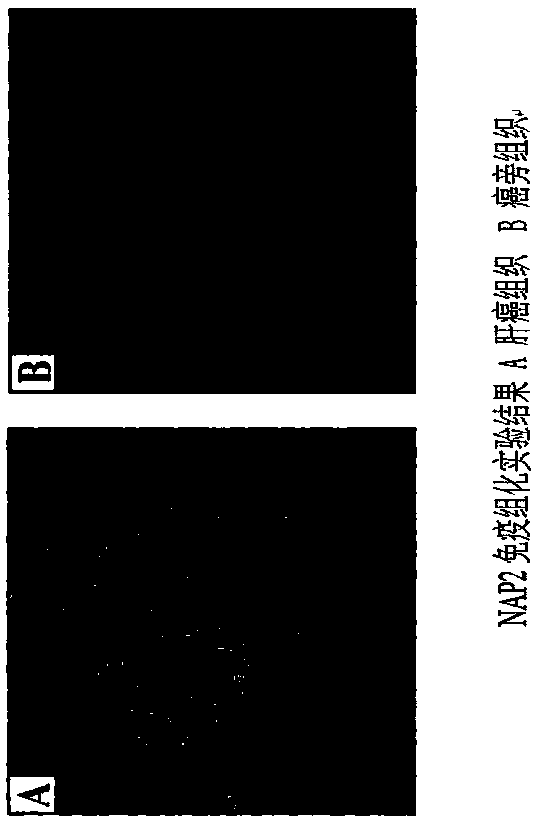 Method for detecting expression of NAP2 in liver cancer and para-carcinoma tissue through immunohistochemical detection