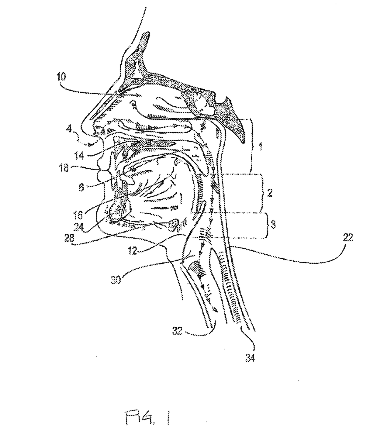 Systems and methods for treatment of sleep apnea