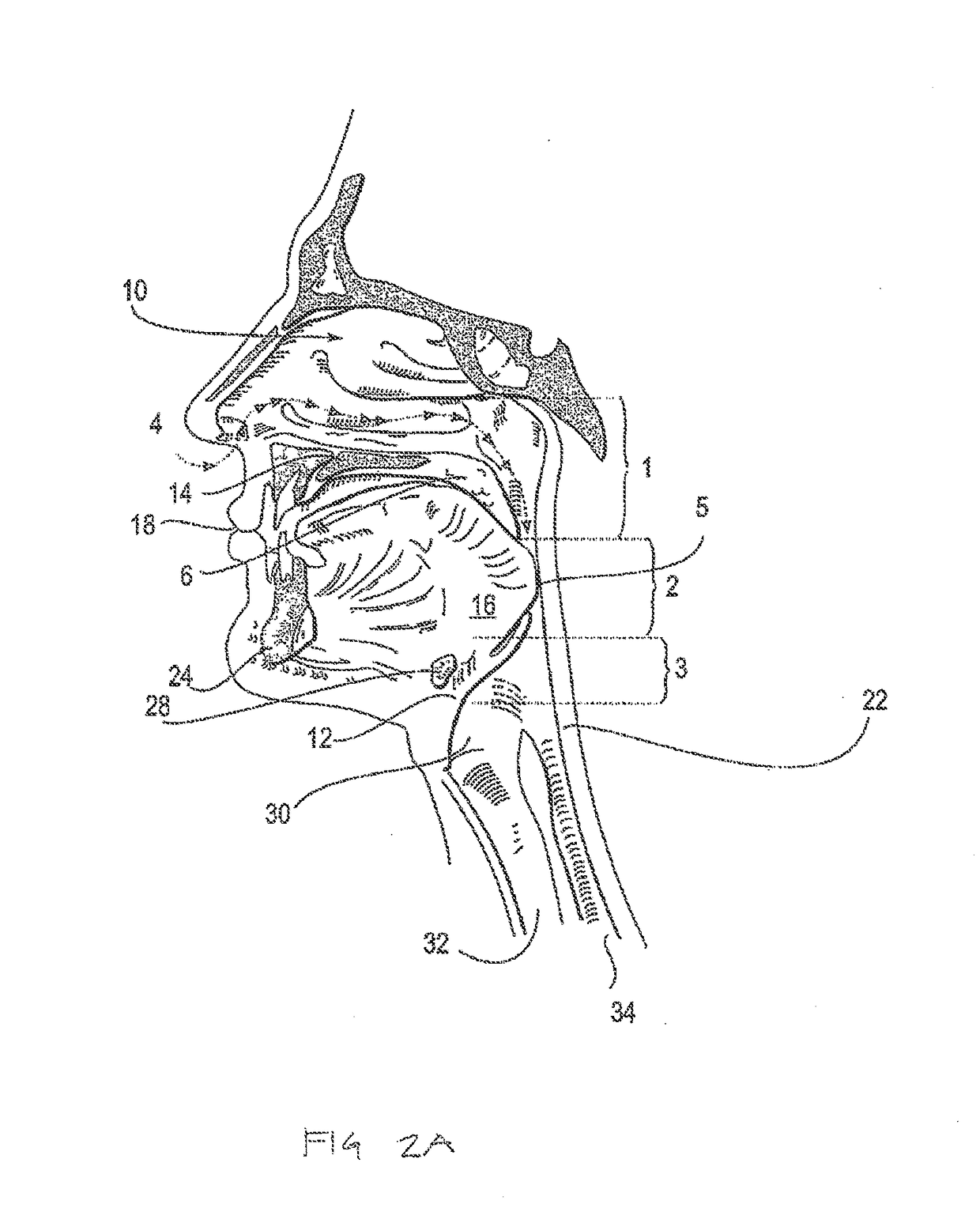 Systems and methods for treatment of sleep apnea