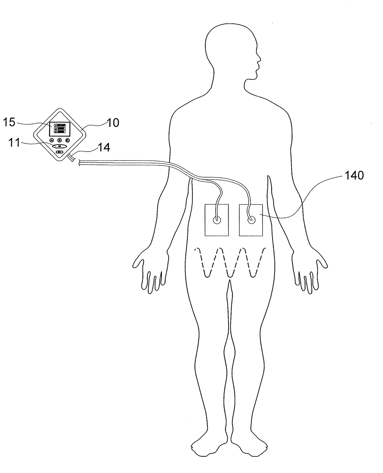 System and method for relieving high blood sugar factor of diabetes