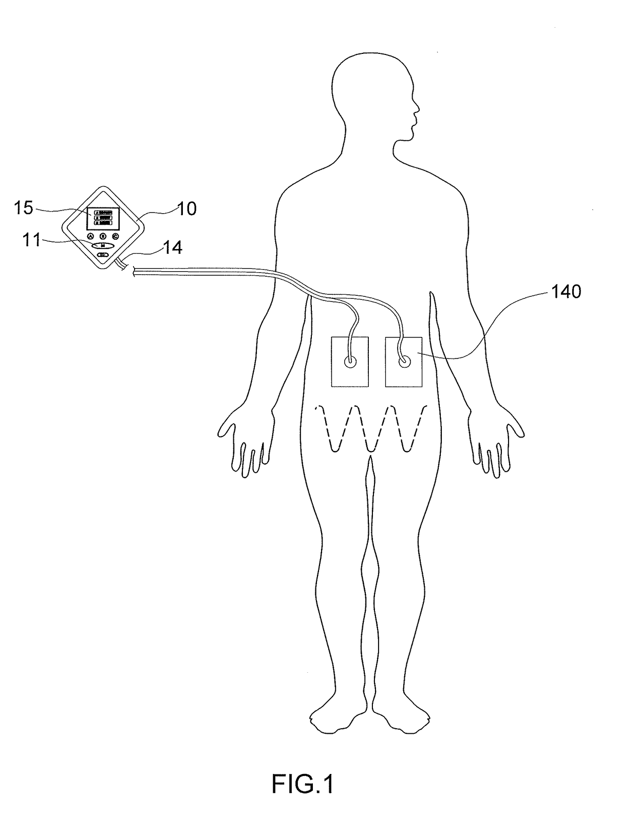 System and method for relieving high blood sugar factor of diabetes