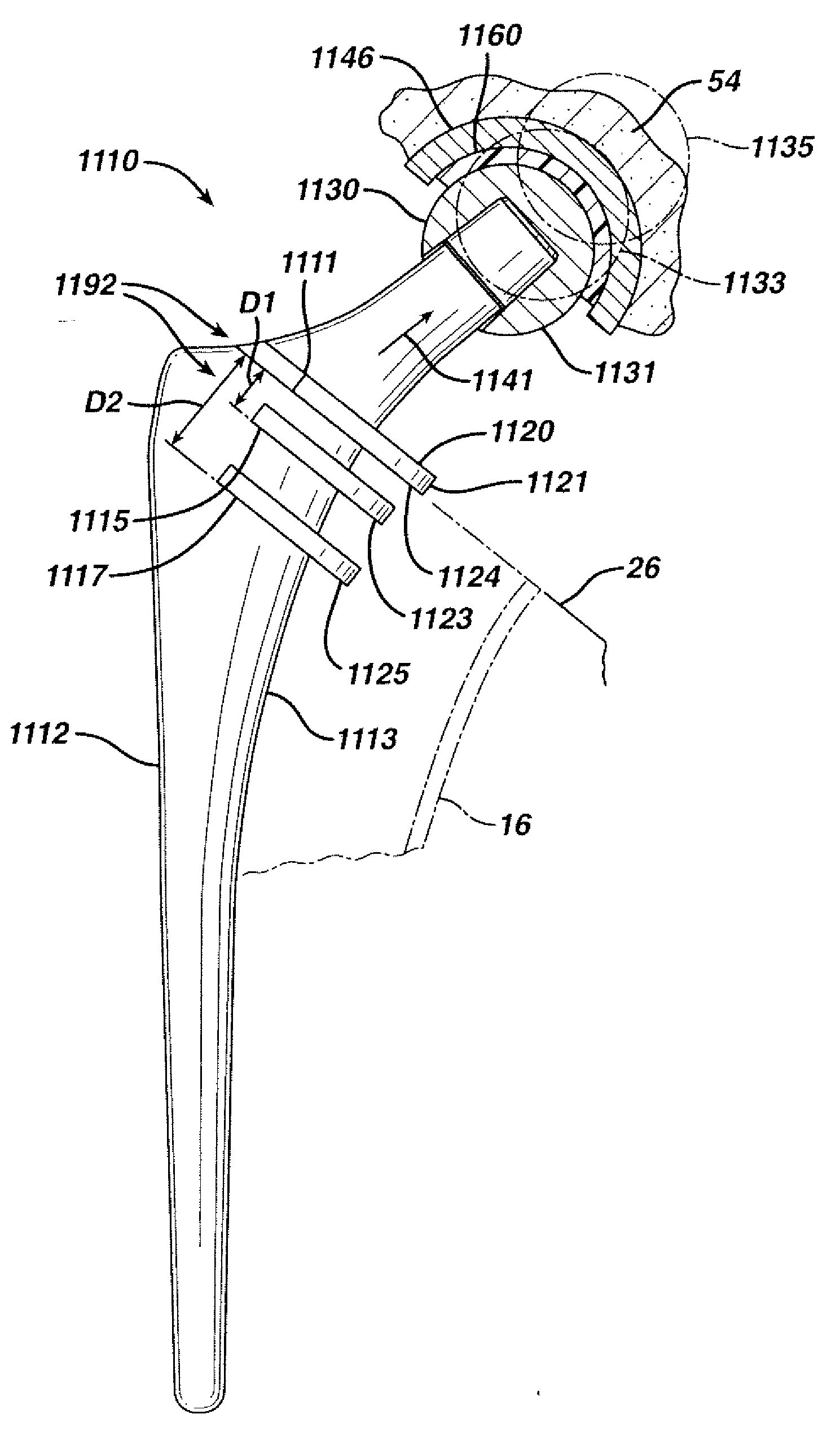 Prosthesis with resorbable collar